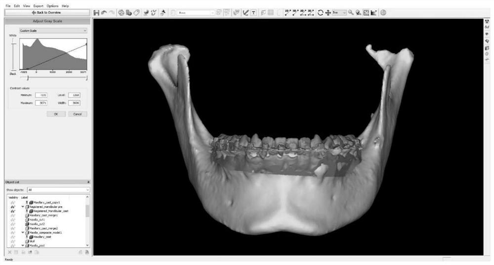 A digital manufacturing method of soft and hard tissue protection jaw pad in oral surgery