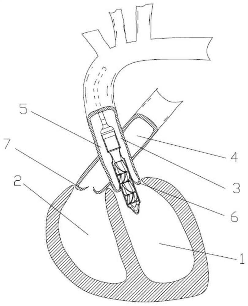 Large-flow two-stage catheter pump for left ventricle assistance and use method of large-flow two-stage catheter pump