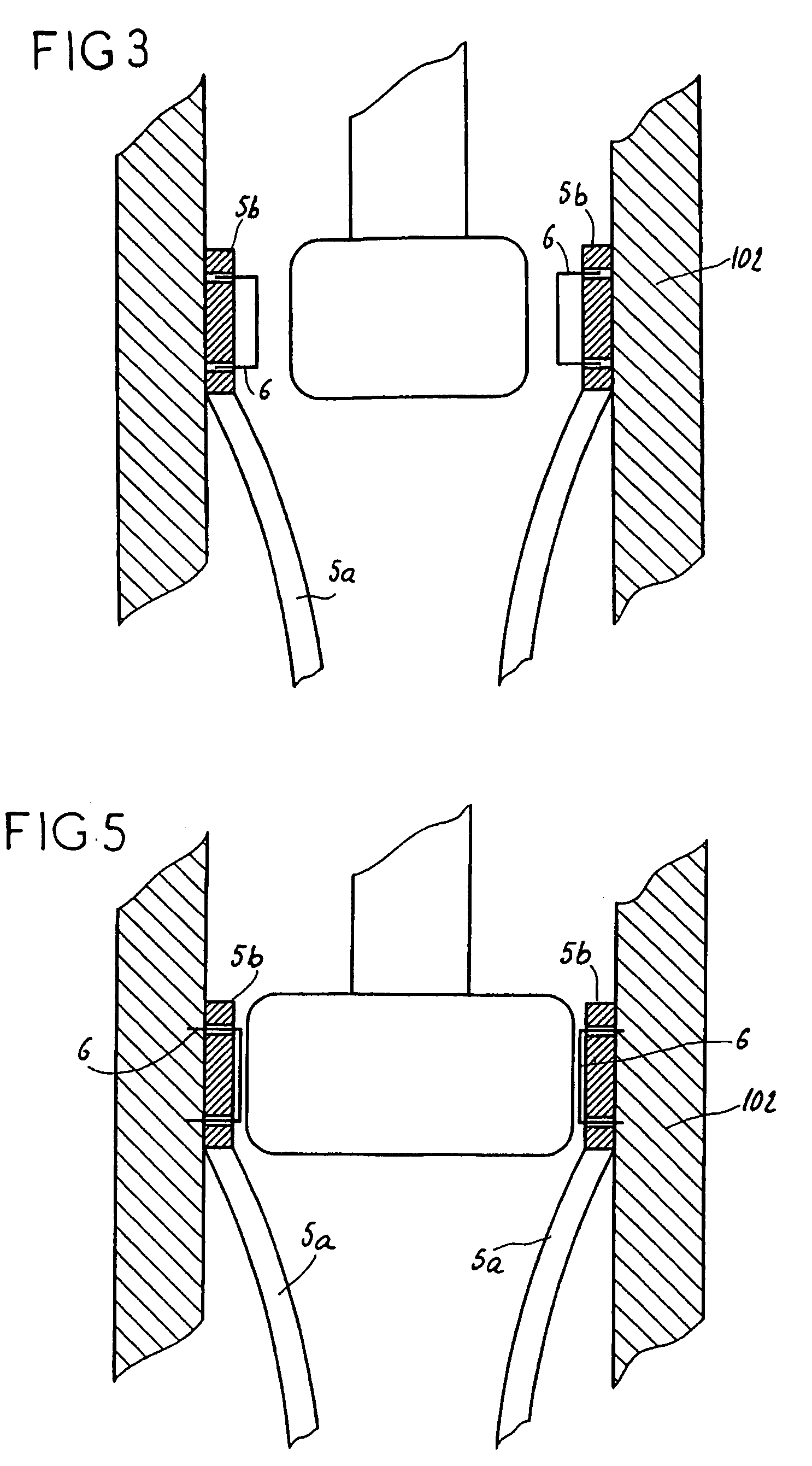 Assembly for setting a valve prosthesis in a corporeal duct