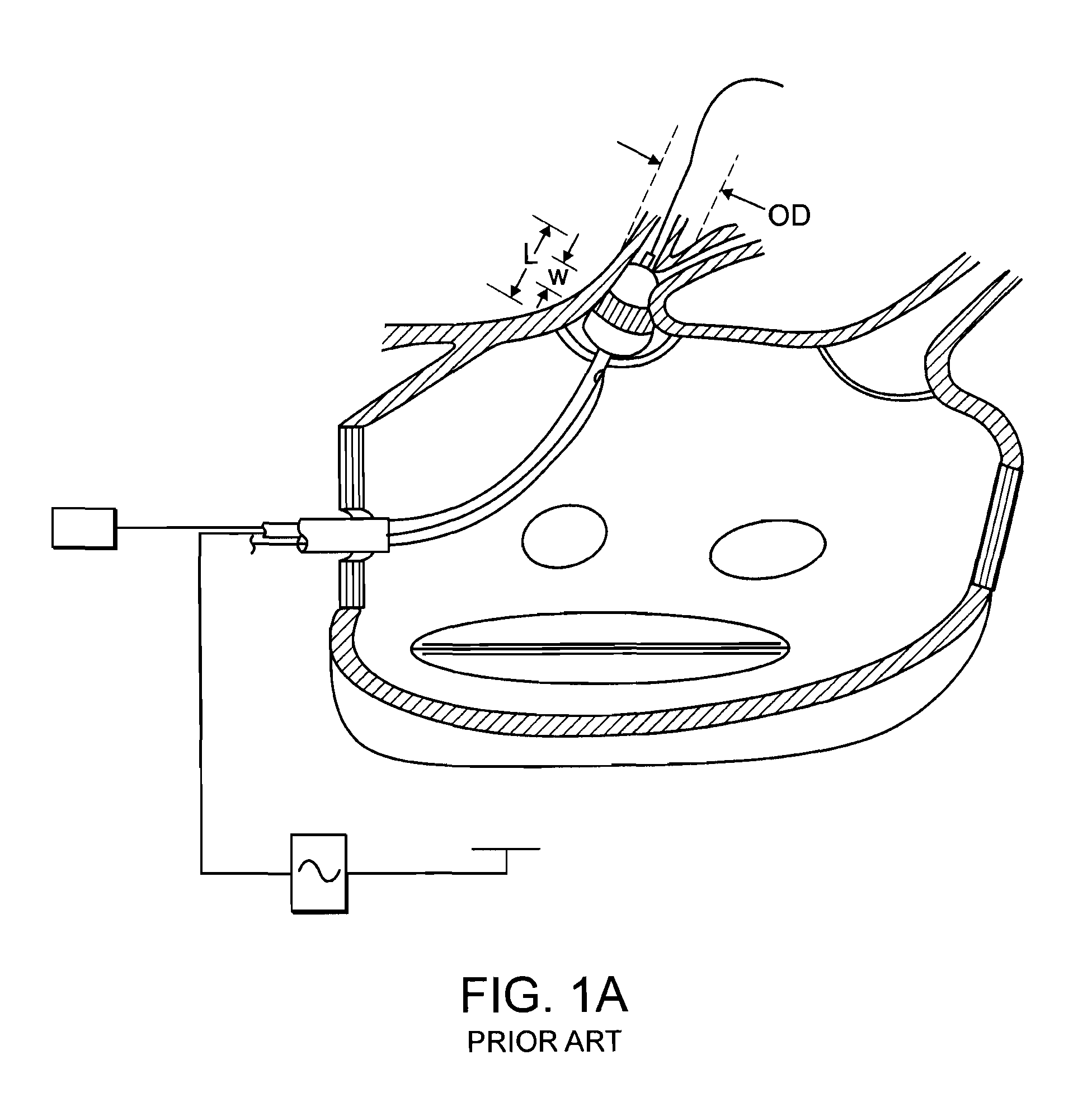 Catheter and method for ablation of atrial tissue