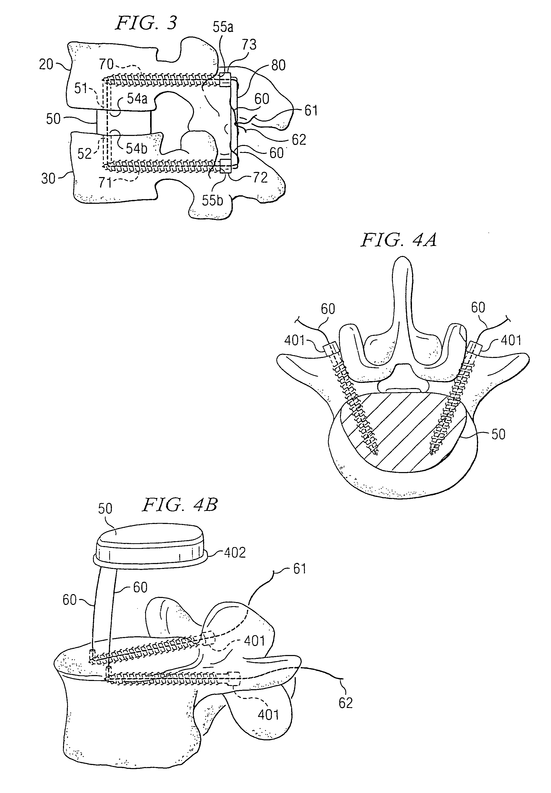 Nucleus replacement securing device and method