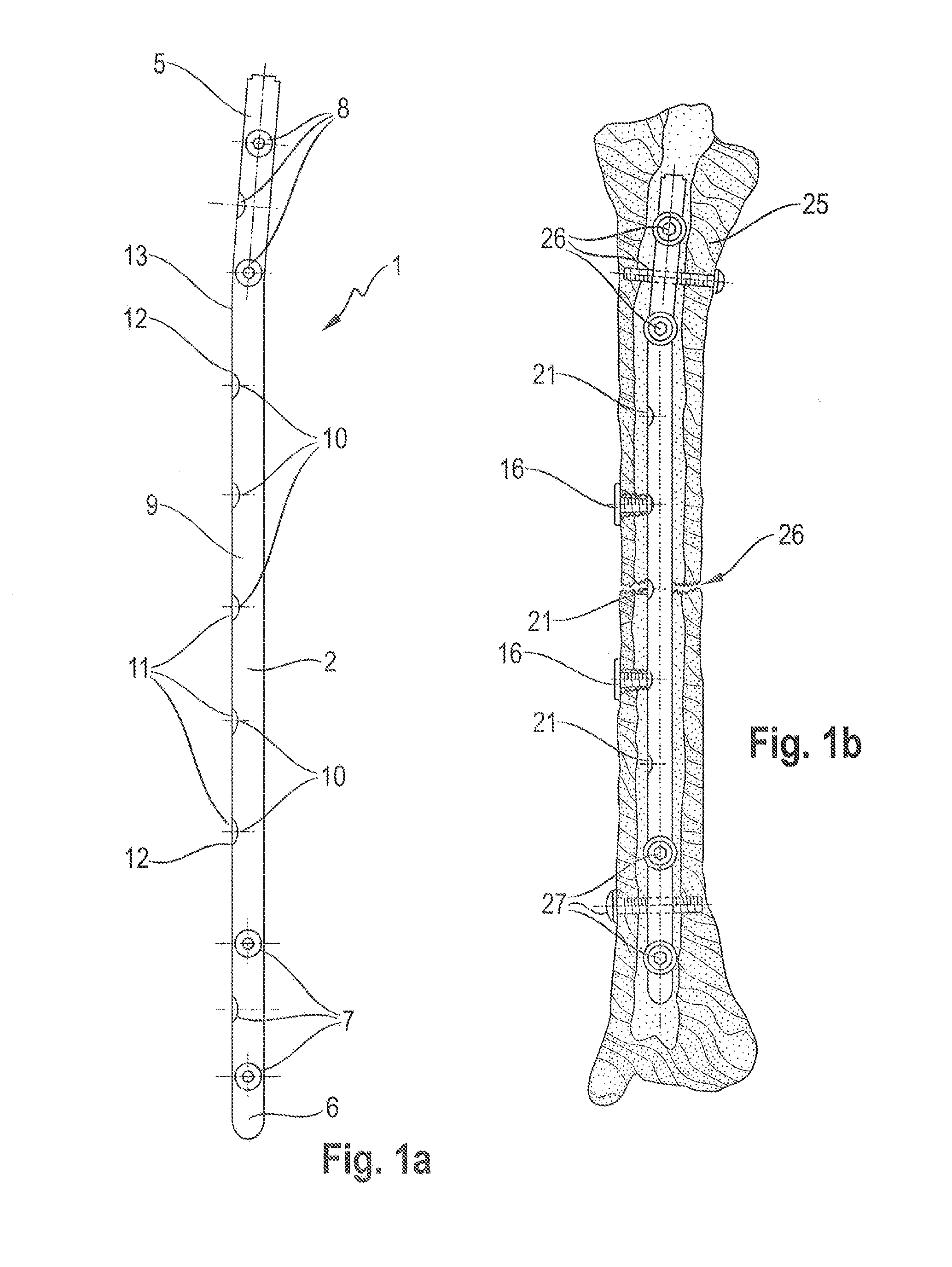 Osteosynthesis system for the multidirectional, angular-stable treatment of fractures of tubular bones comprising an intramedullary nail and bone screws
