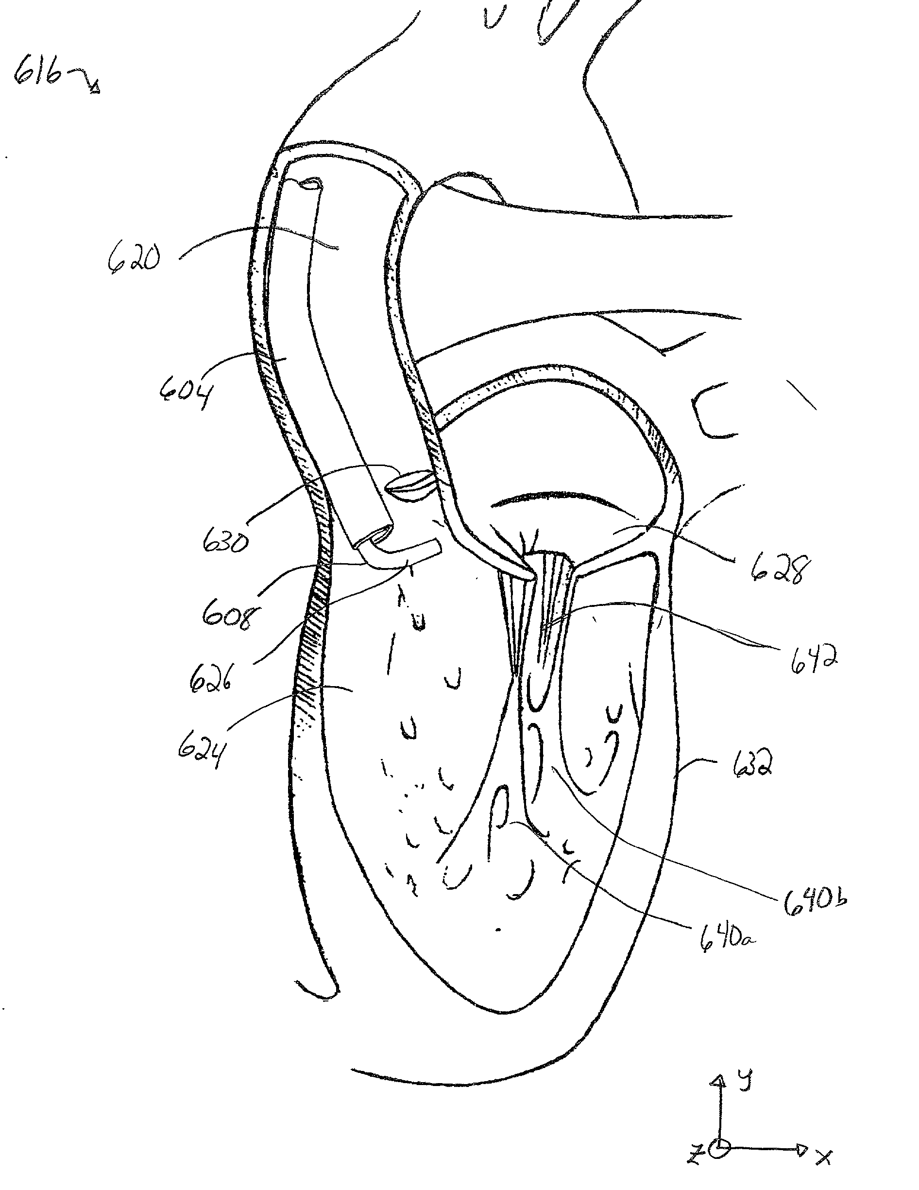 Method and apparatus for catheter-based annuloplasty
