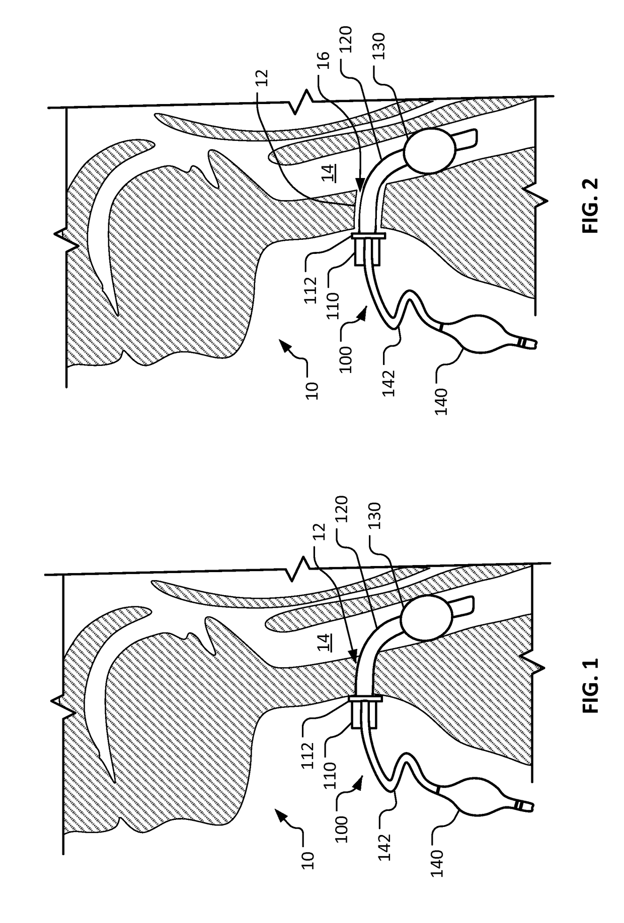 Double cuff tracheostomy device