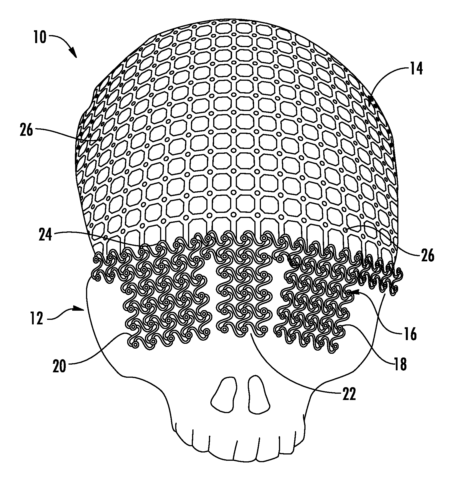 Universal Cranioplasty Mesh