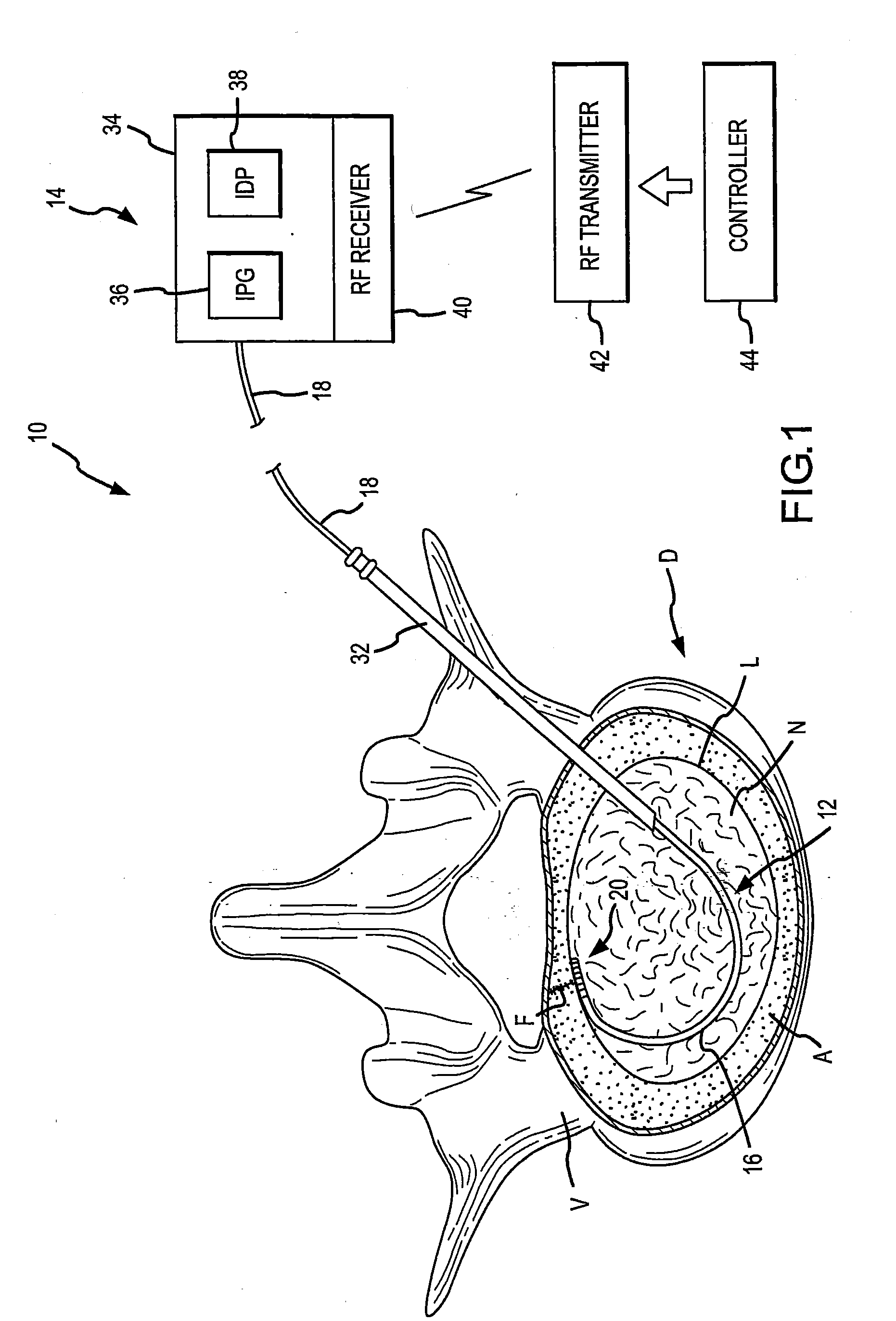 Combination electrical stimulating and infusion device and method
