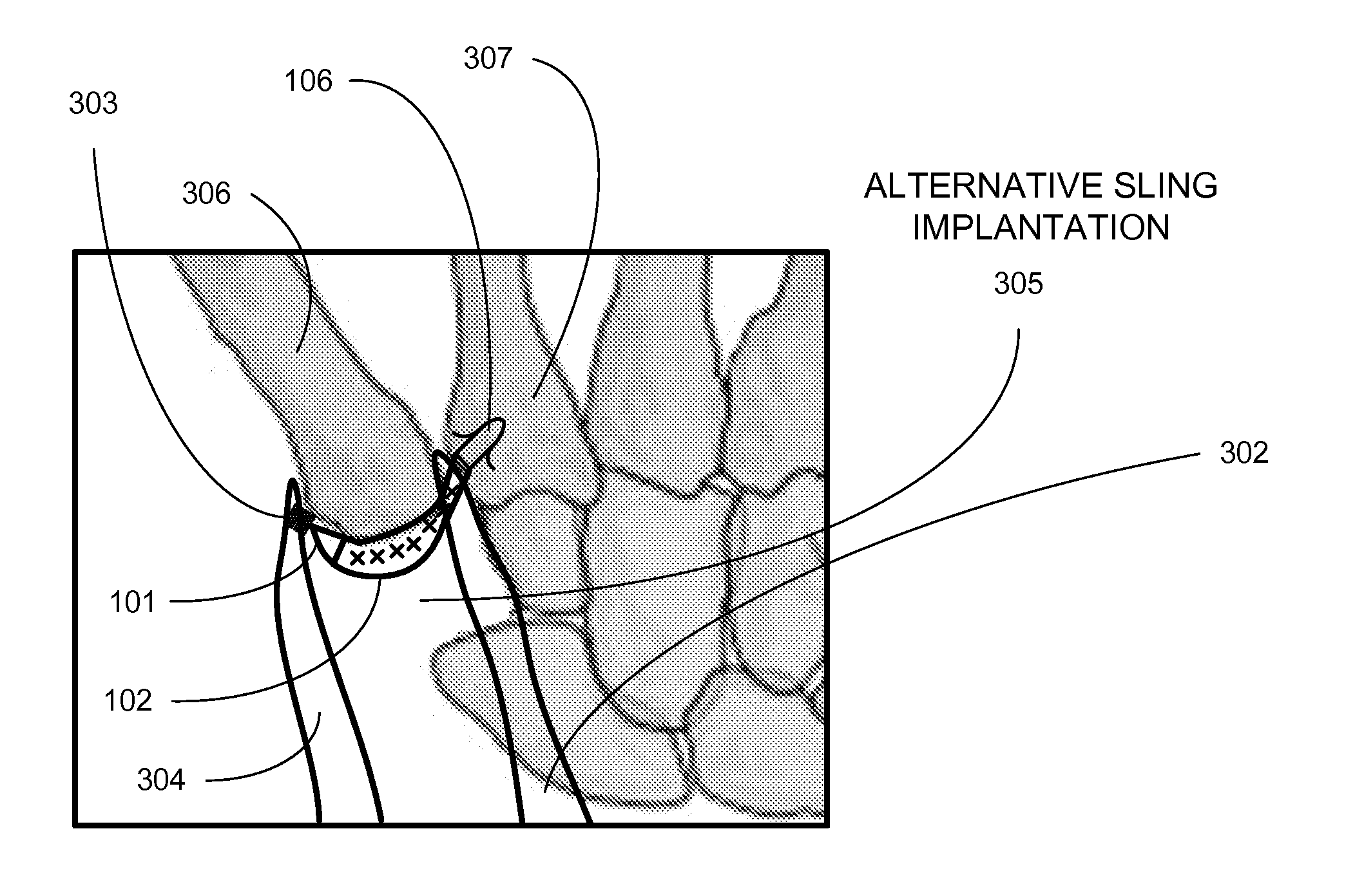 Surgical implantable stabilizer sling for basal joint arthroplasty