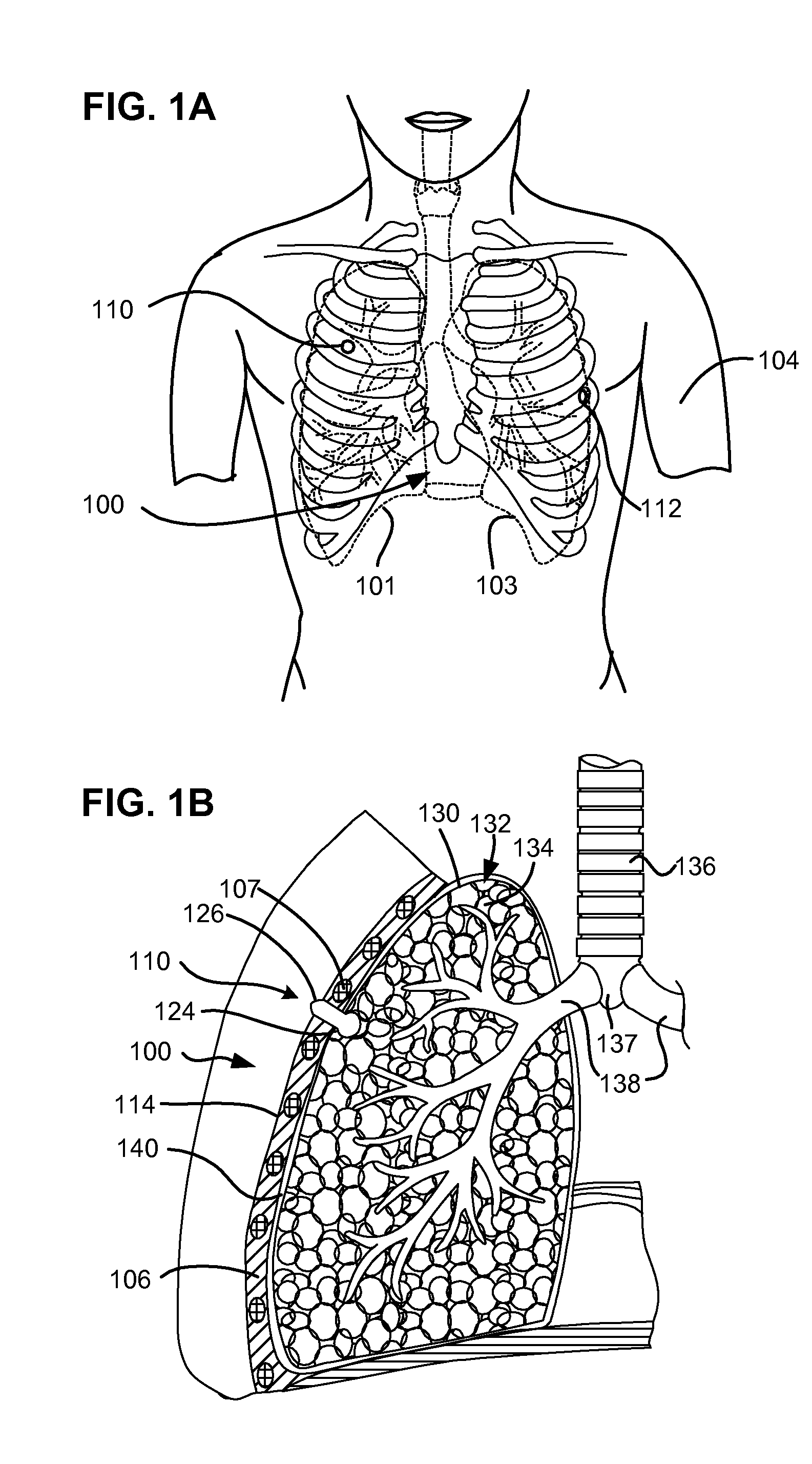 Flexible pneumostoma management system and methods for treatment of chronic obstructive pulmonary disease