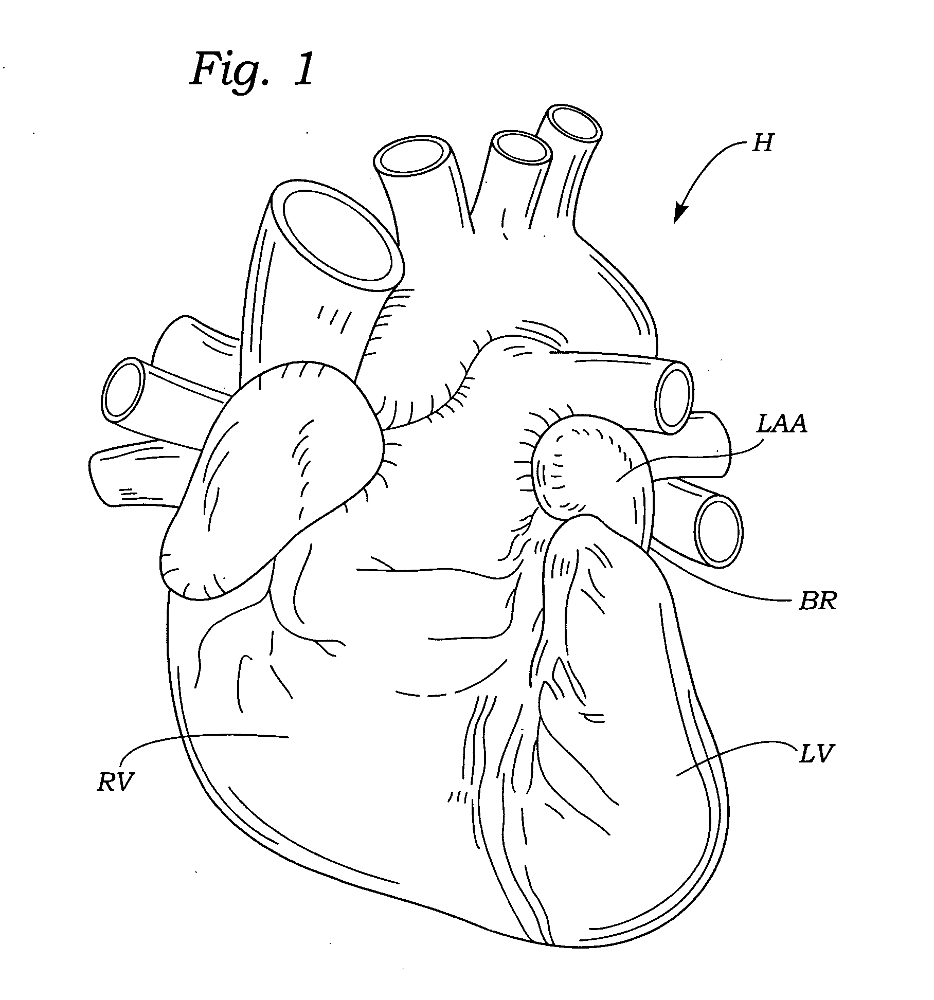 Left atrial appendage exclusion device