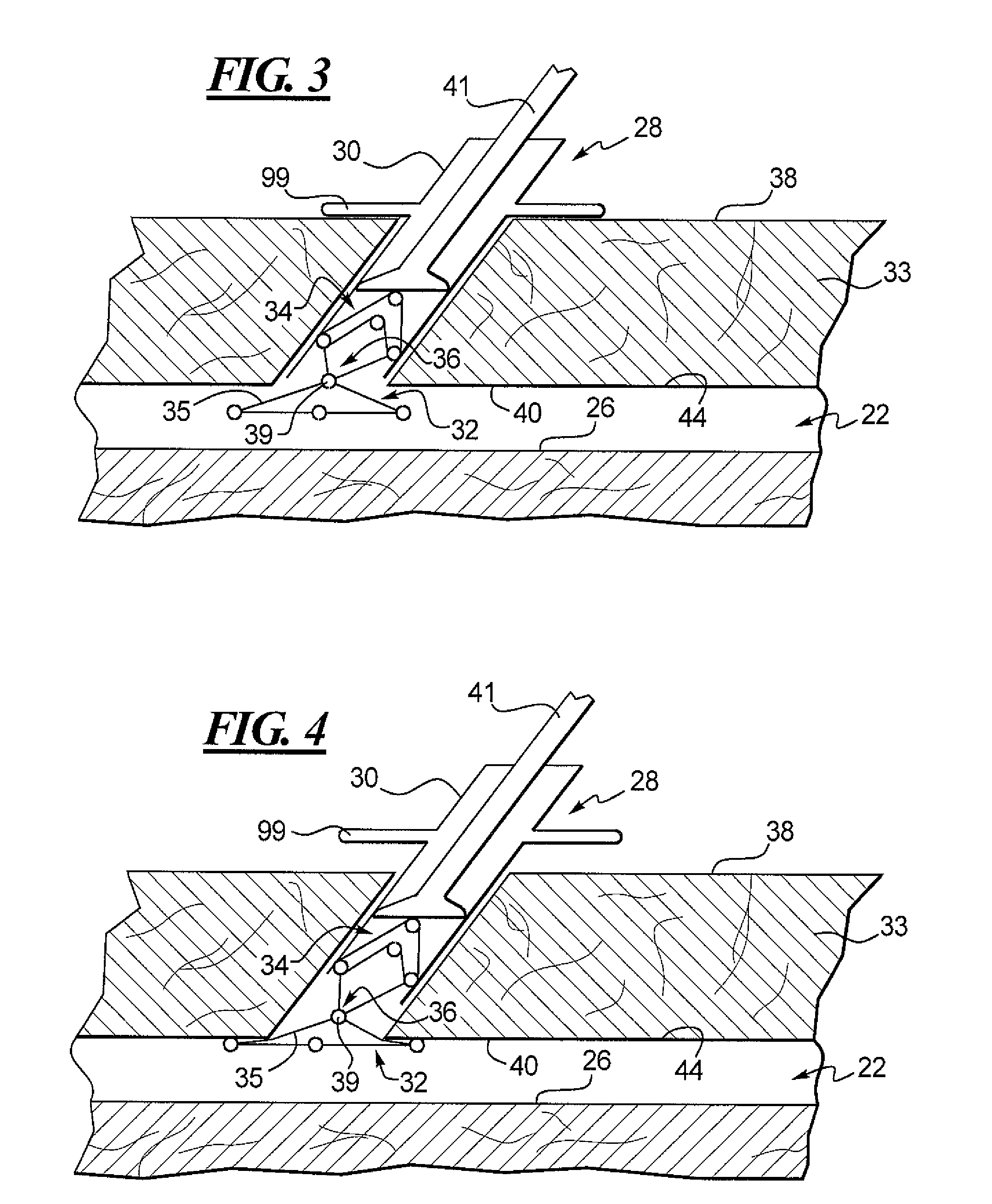 Apparatus and Method for Closing an Opening in a Blood Vessel Using a Permanent Implant