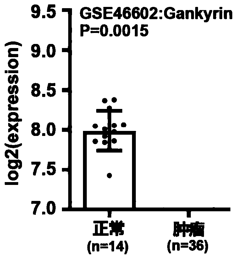 Application of Gankyrin protein as novel molecular marker in prognosis evaluation of prostate cancer