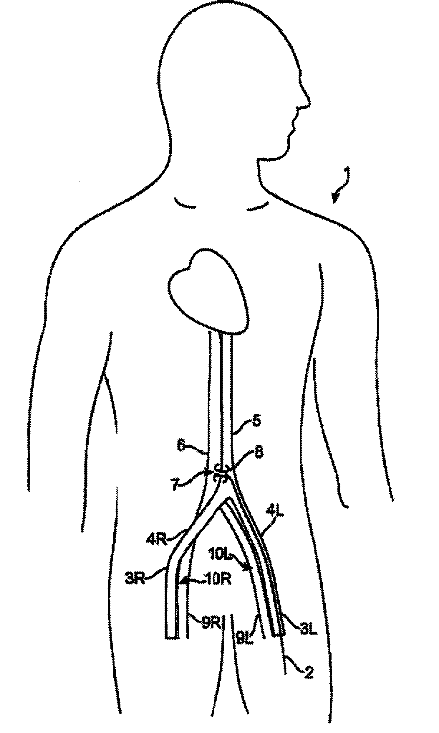 Device and method for establishing an artificial arterio-venous fistula