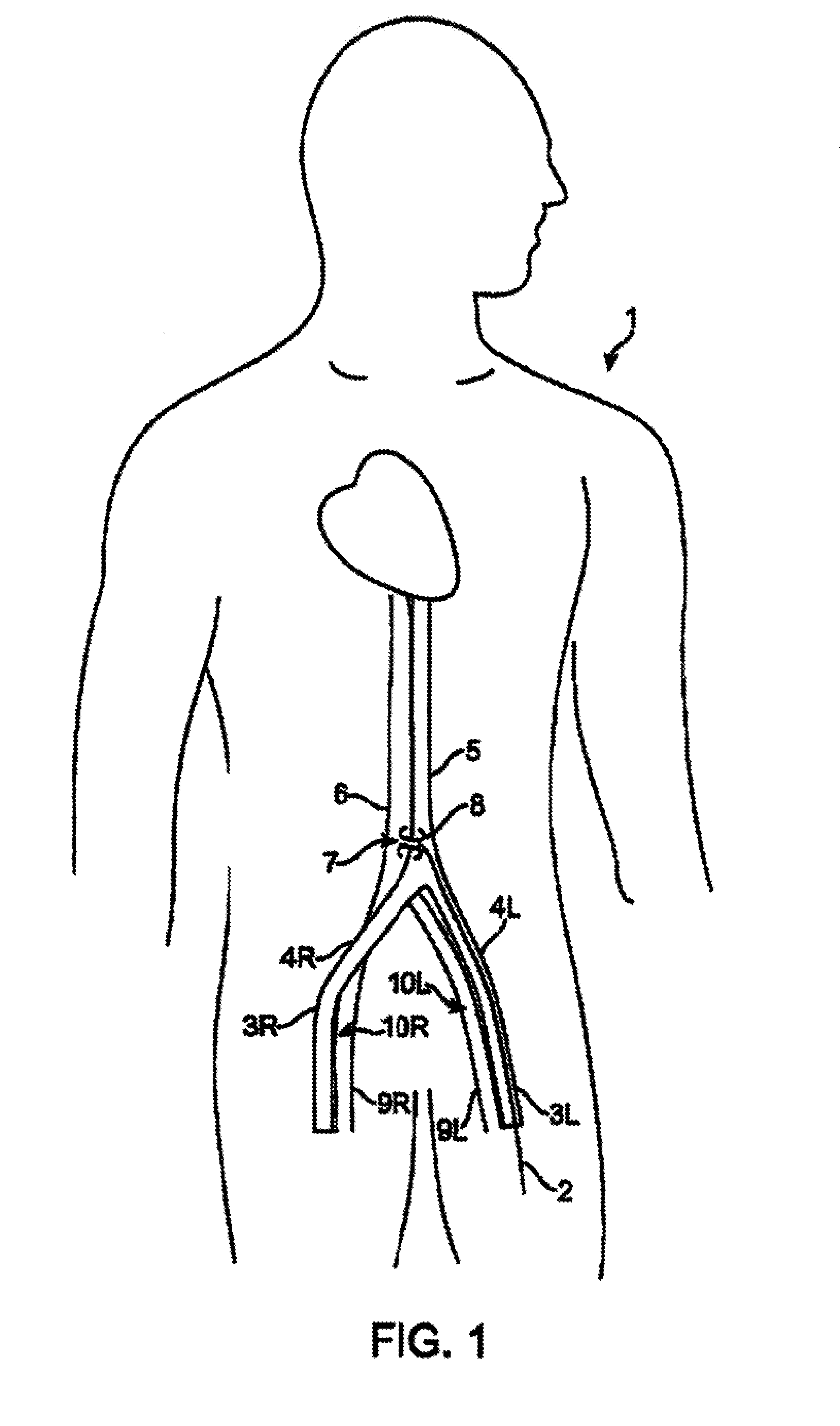 Device and method for establishing an artificial arterio-venous fistula