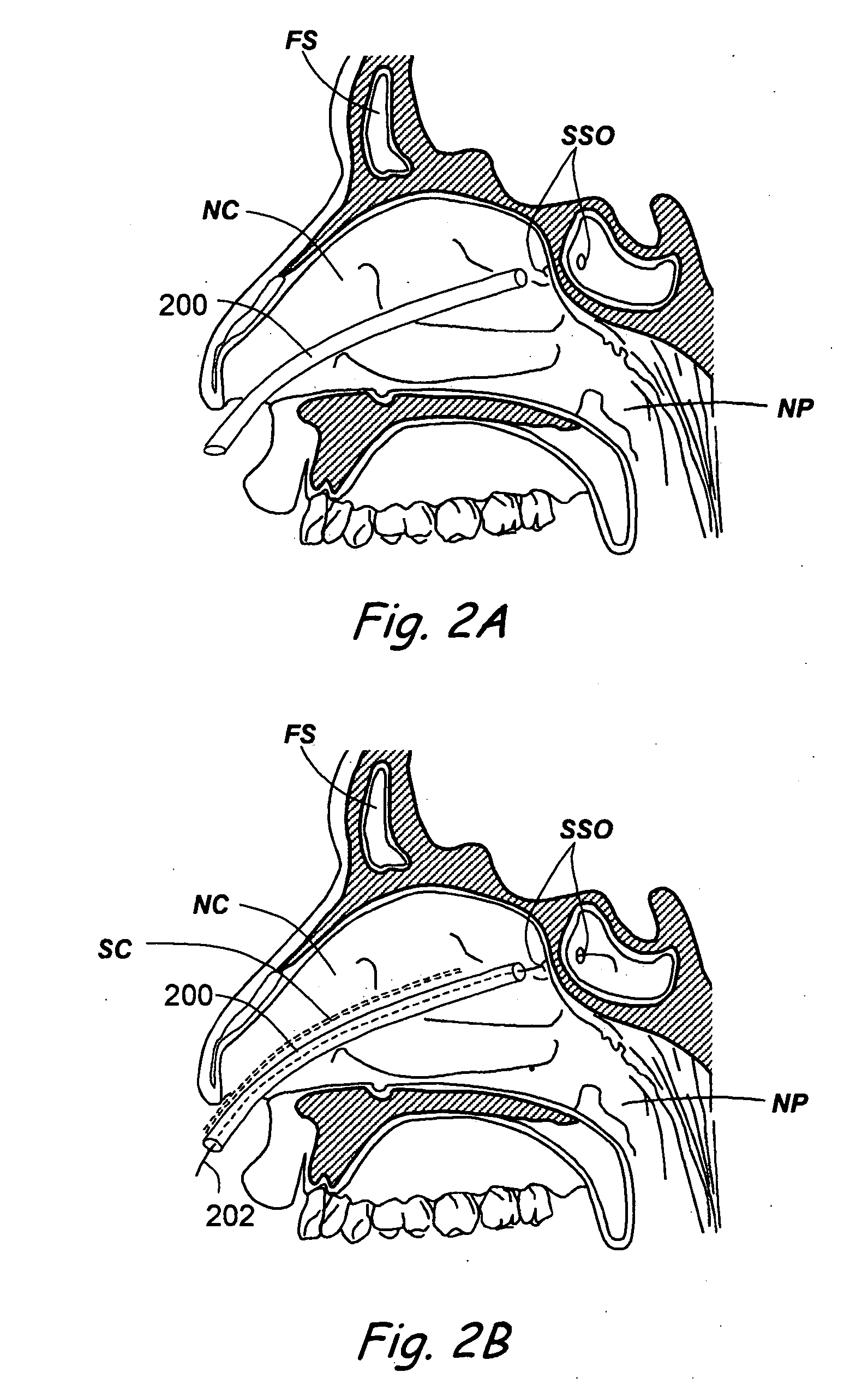 Devices, systems and methods useable for treating sinusitis