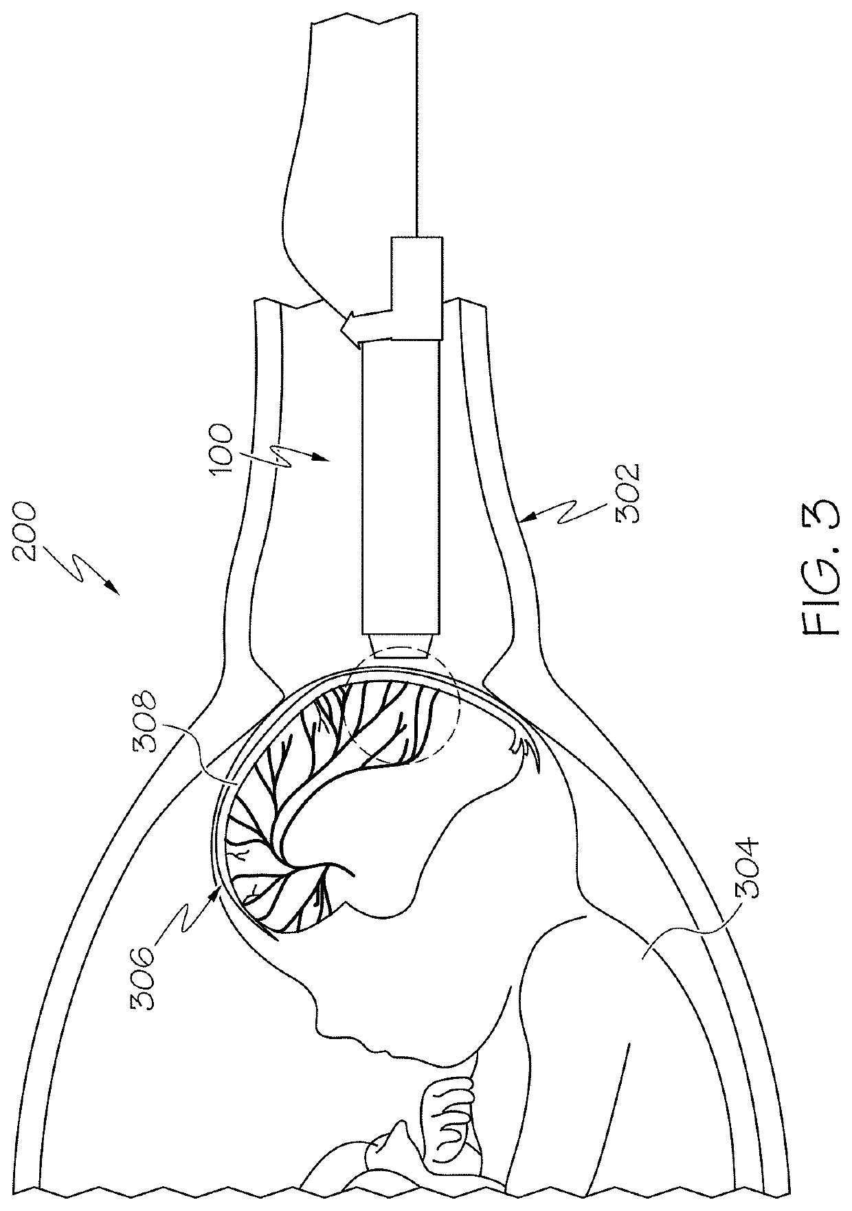 Ultrasound and photoacoustic systems and methods for fetal brain assessment during delivery