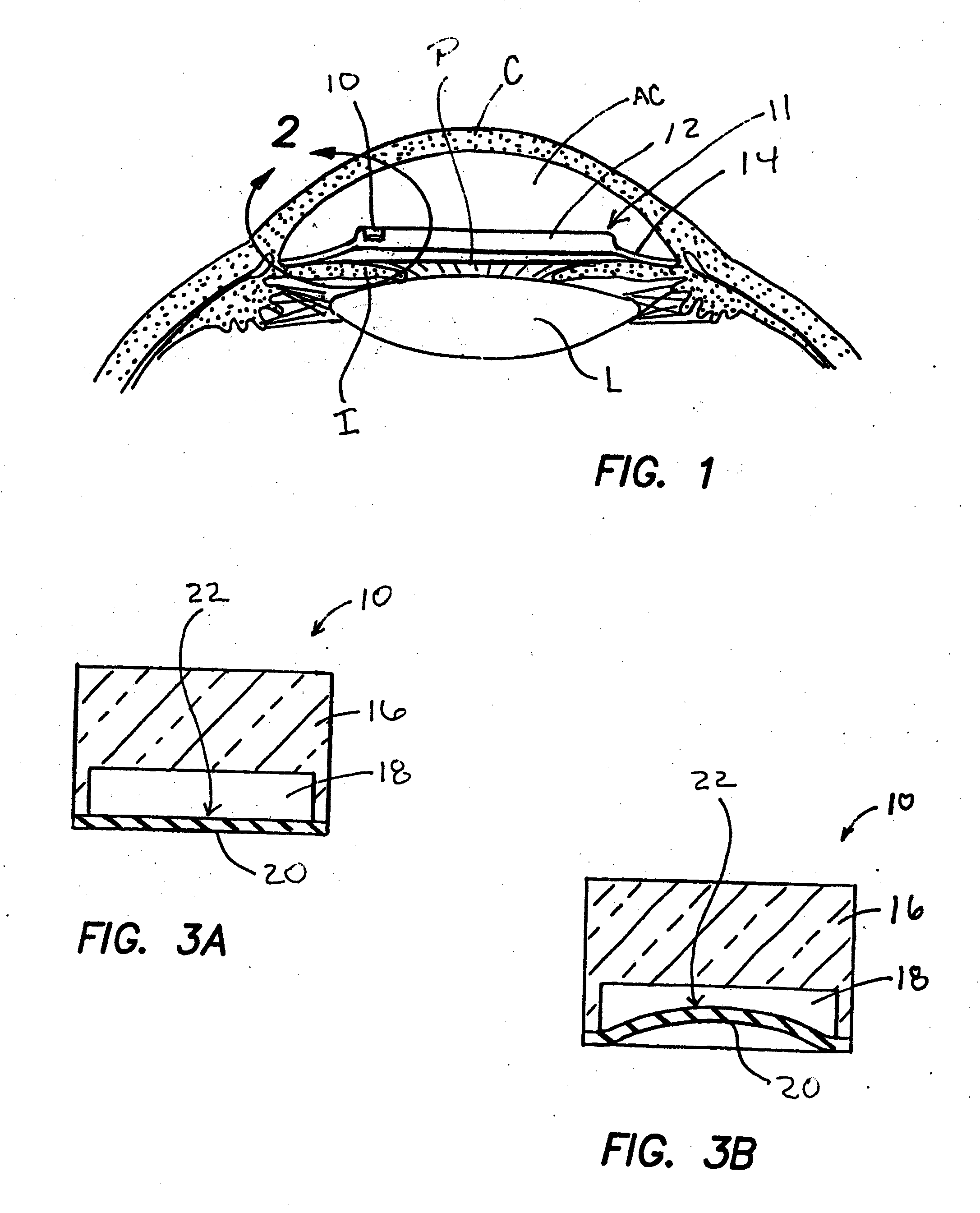 Implantable Devices and Methods for Measuring Intraocular, Subconjunctival or Subdermal Pressure and/or Analyte Concentration