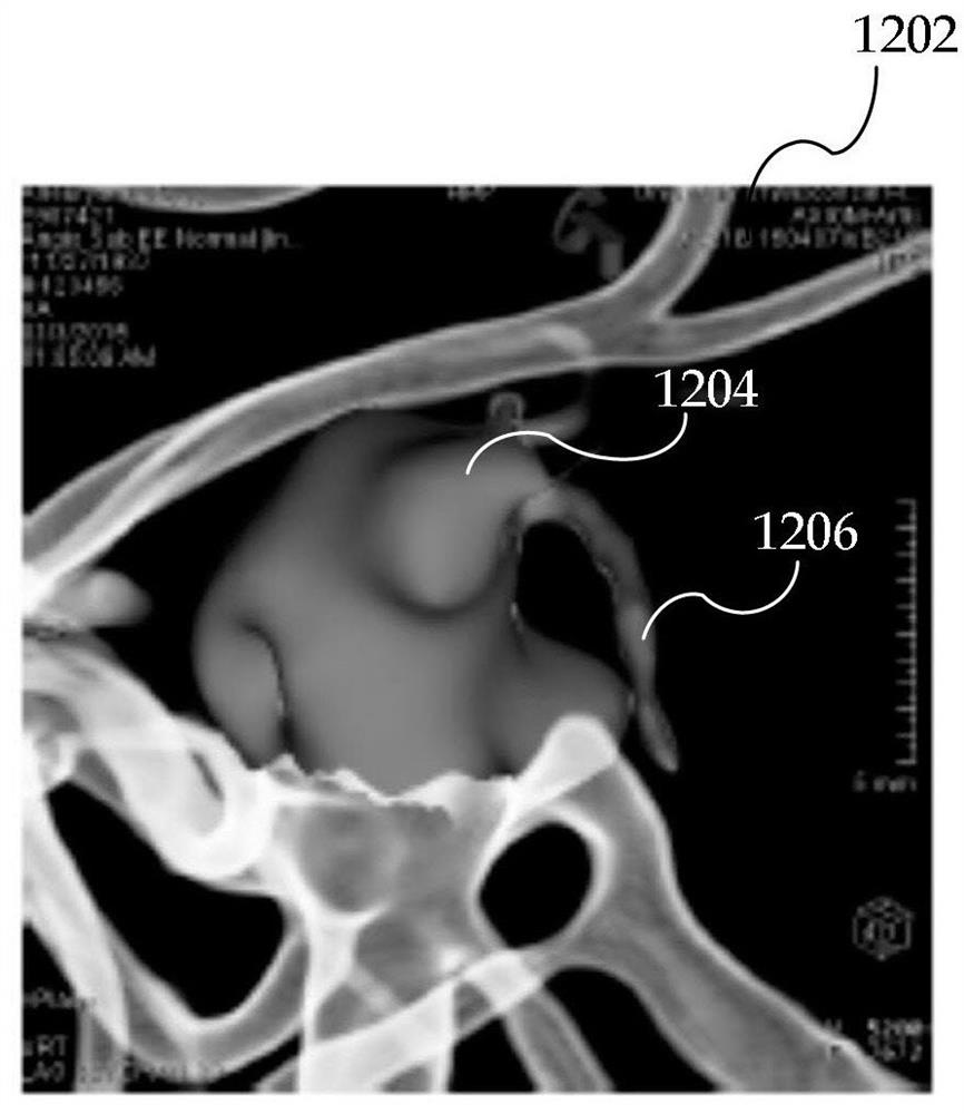 Isolation of aneurysms from parent vessels in volumetric image data