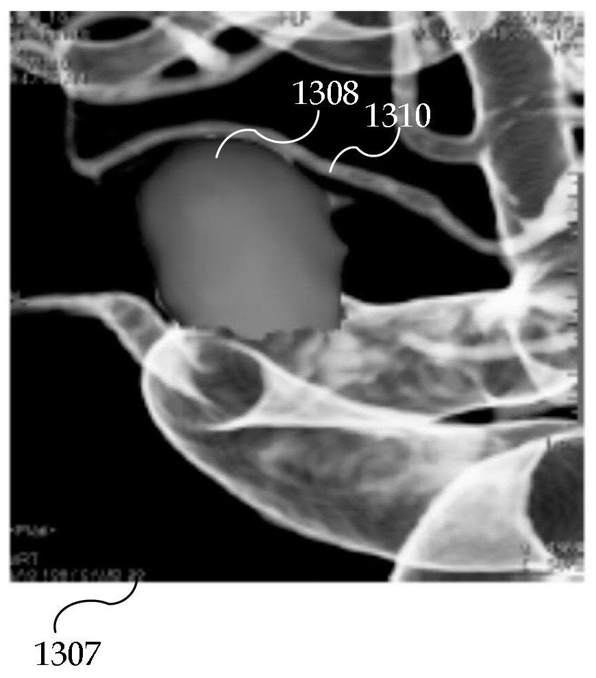 Isolation of aneurysms from parent vessels in volumetric image data