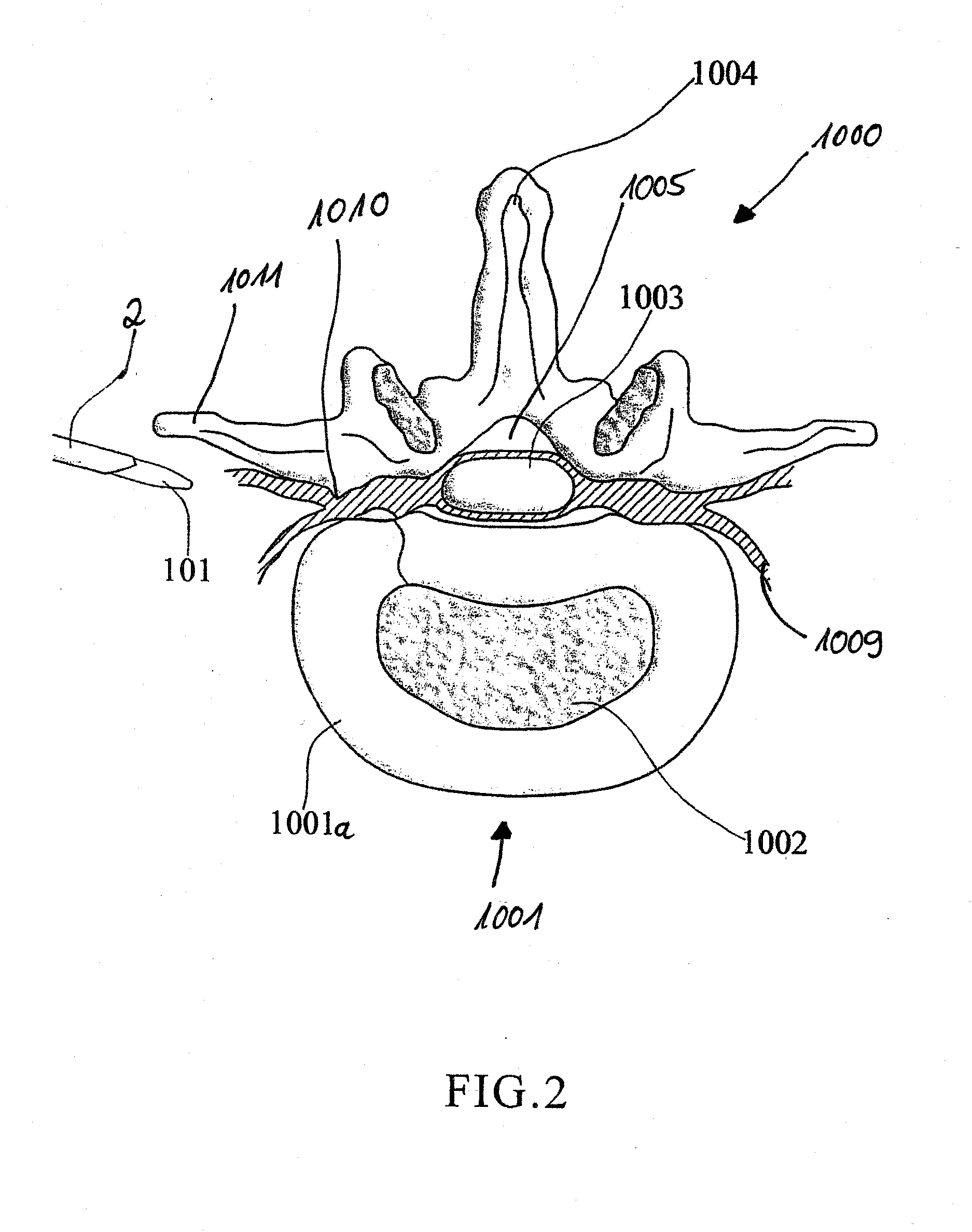 Device and method for minimally invasive spinal intervention