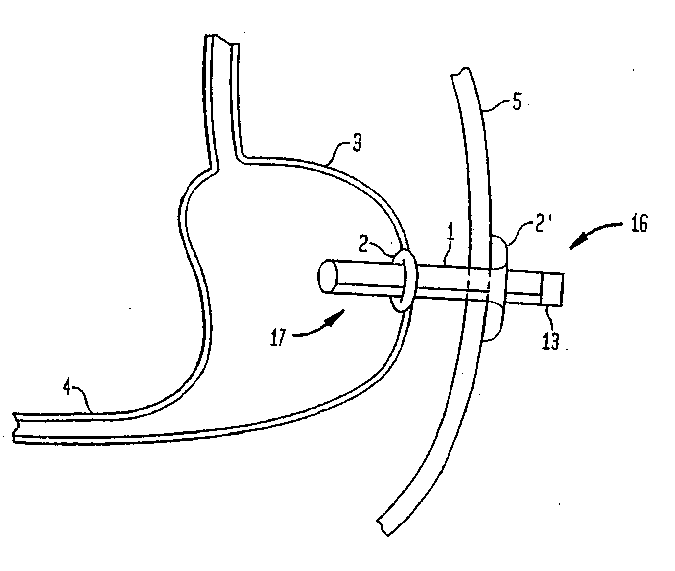 Shunt Apparatus For Treating Obesity By Extracting Food