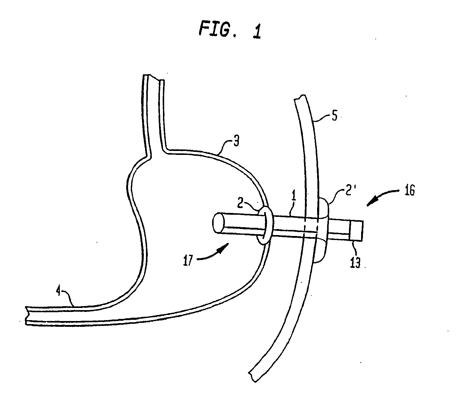 Shunt Apparatus For Treating Obesity By Extracting Food