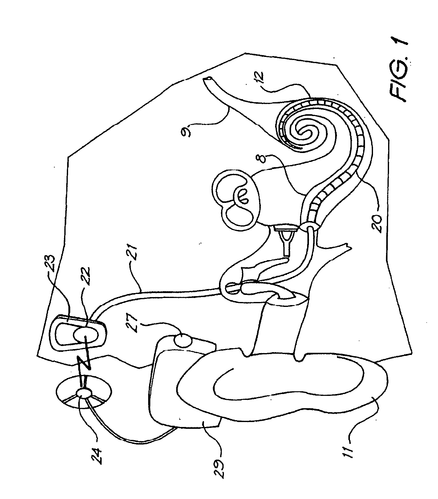 Cochlear implant electrode array