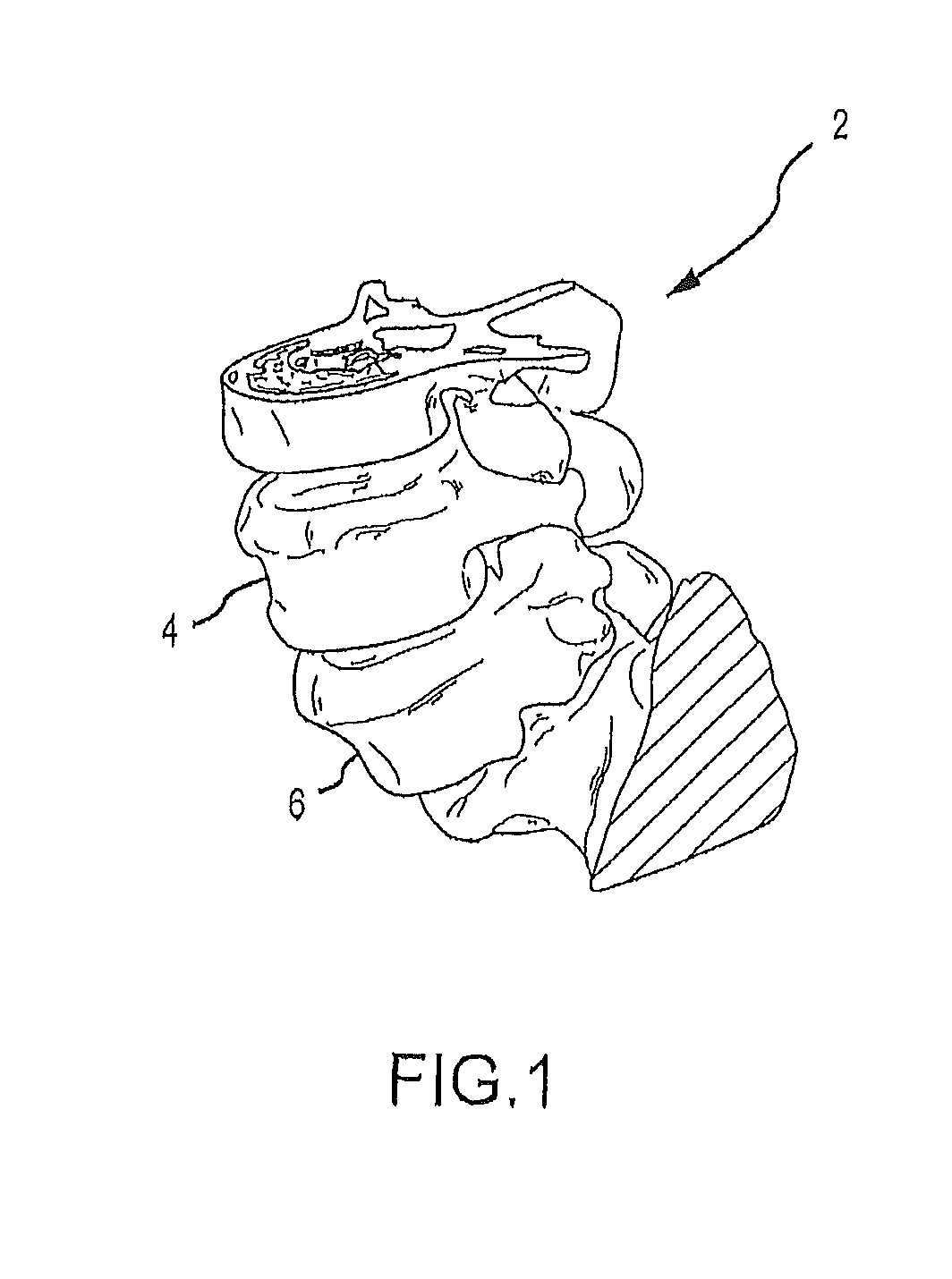 Patient matching surgical guide and method for using the same
