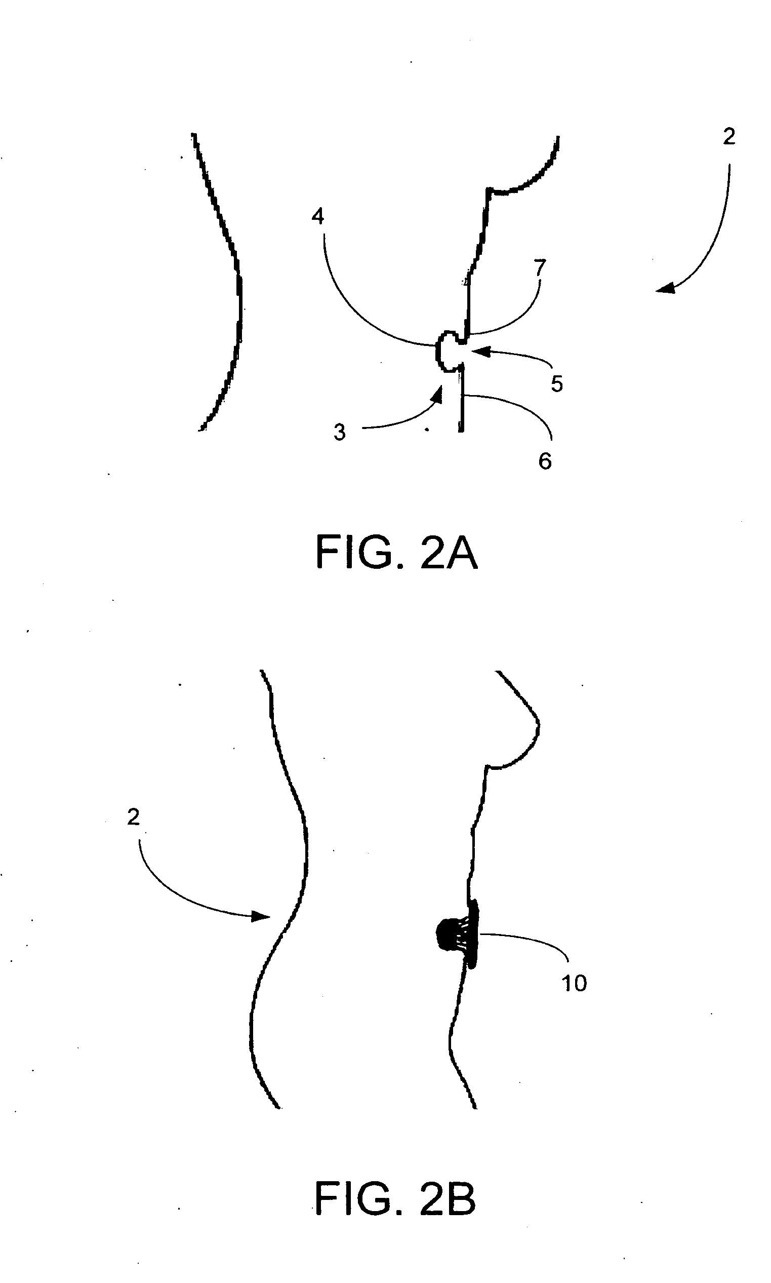Umbilical splint and method of use