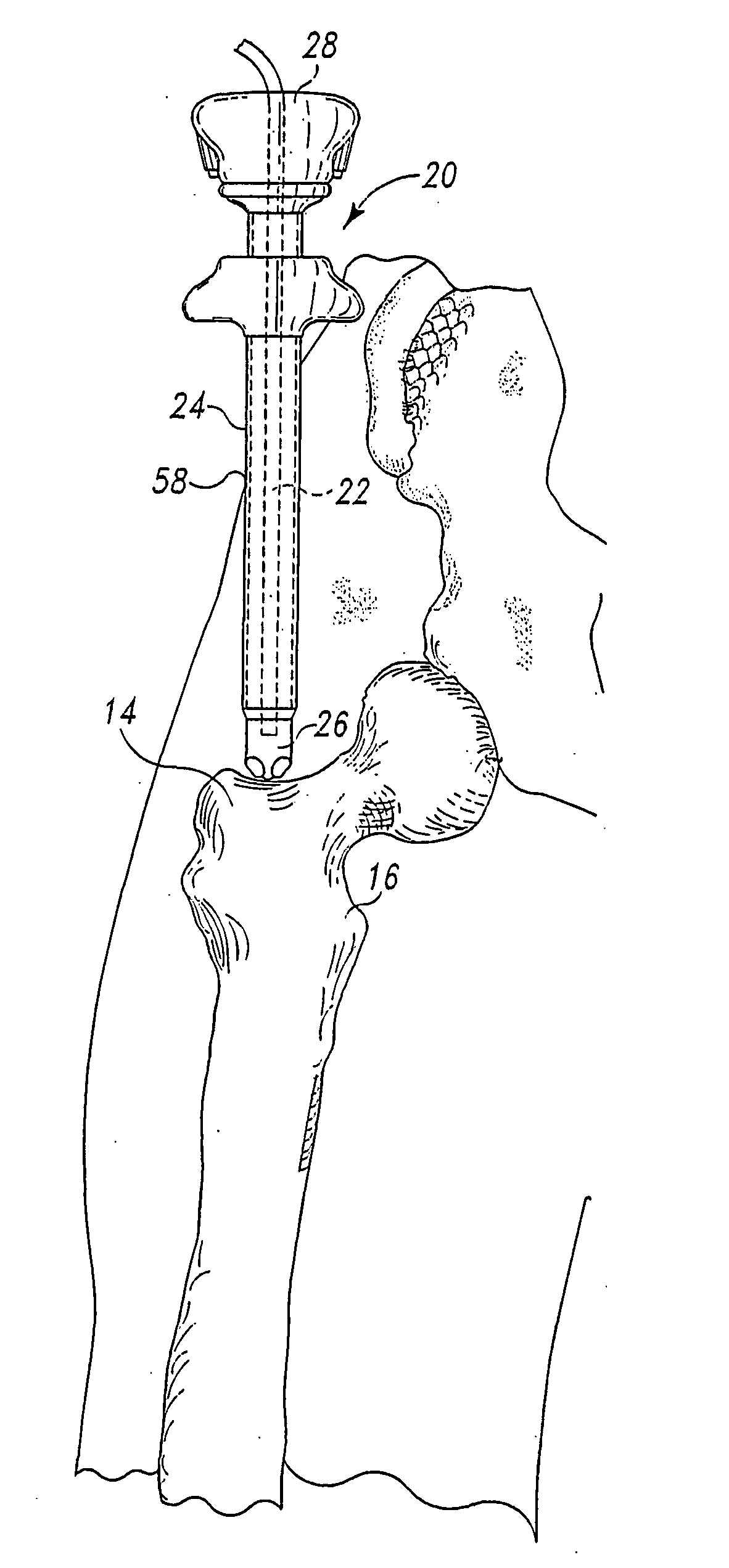 Minimally invasive orthopaedic apparatus and methods