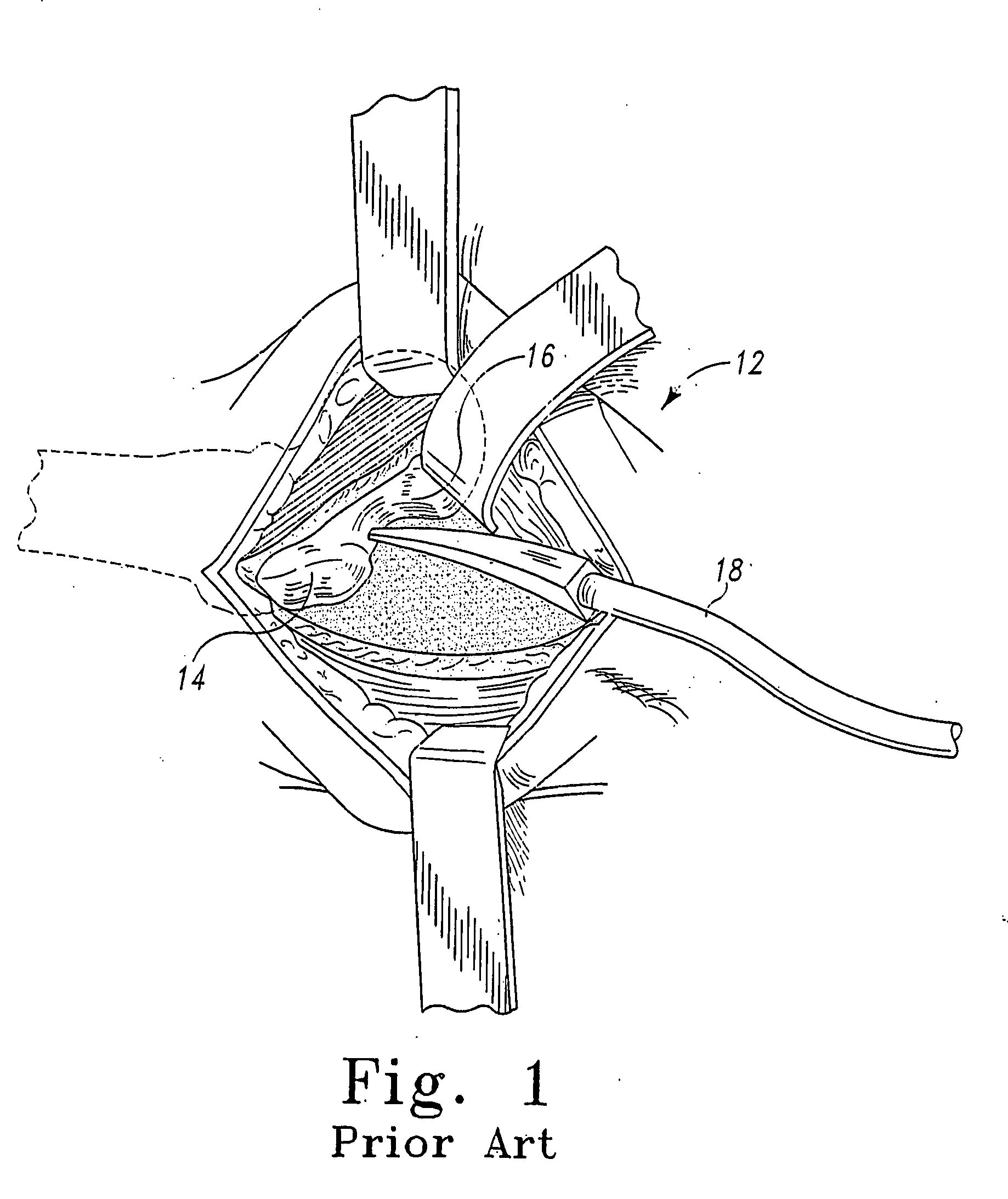 Minimally invasive orthopaedic apparatus and methods