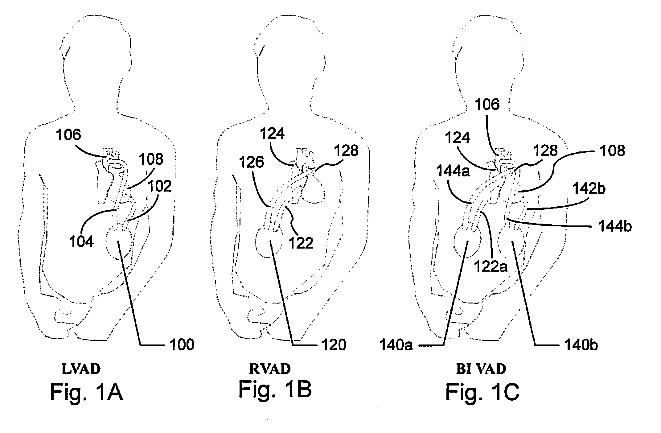 Device and method for connecting a blood pump without trapping air bubbles