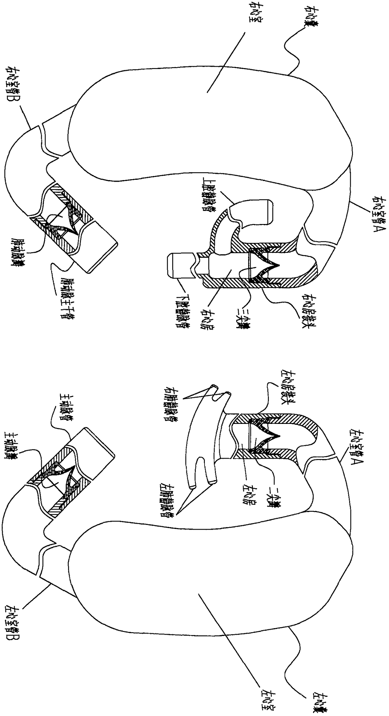 Passive thoracic pressure differential pressure artificial heart and implantation position