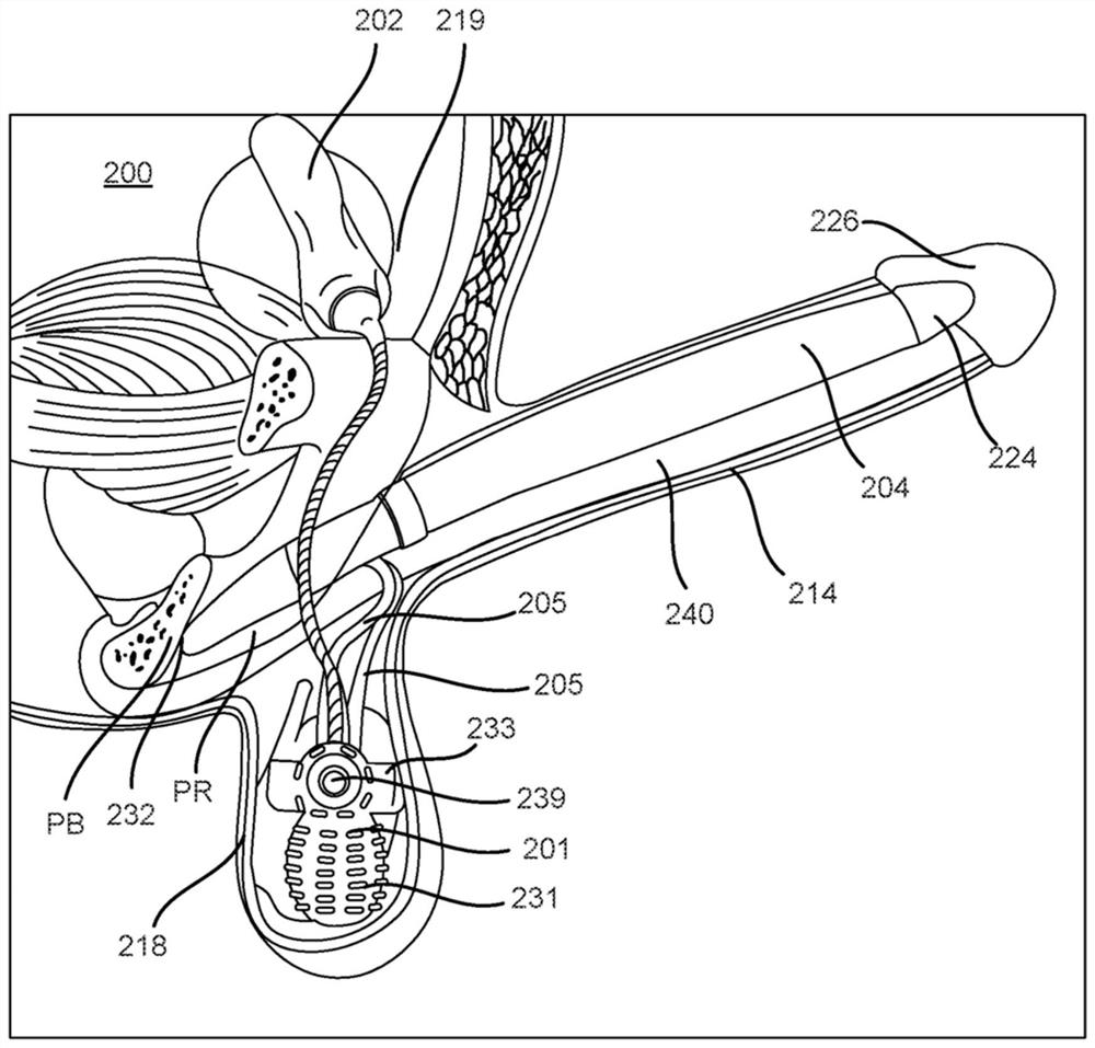 Inflatable penile prosthesis having cylinder with porous portion