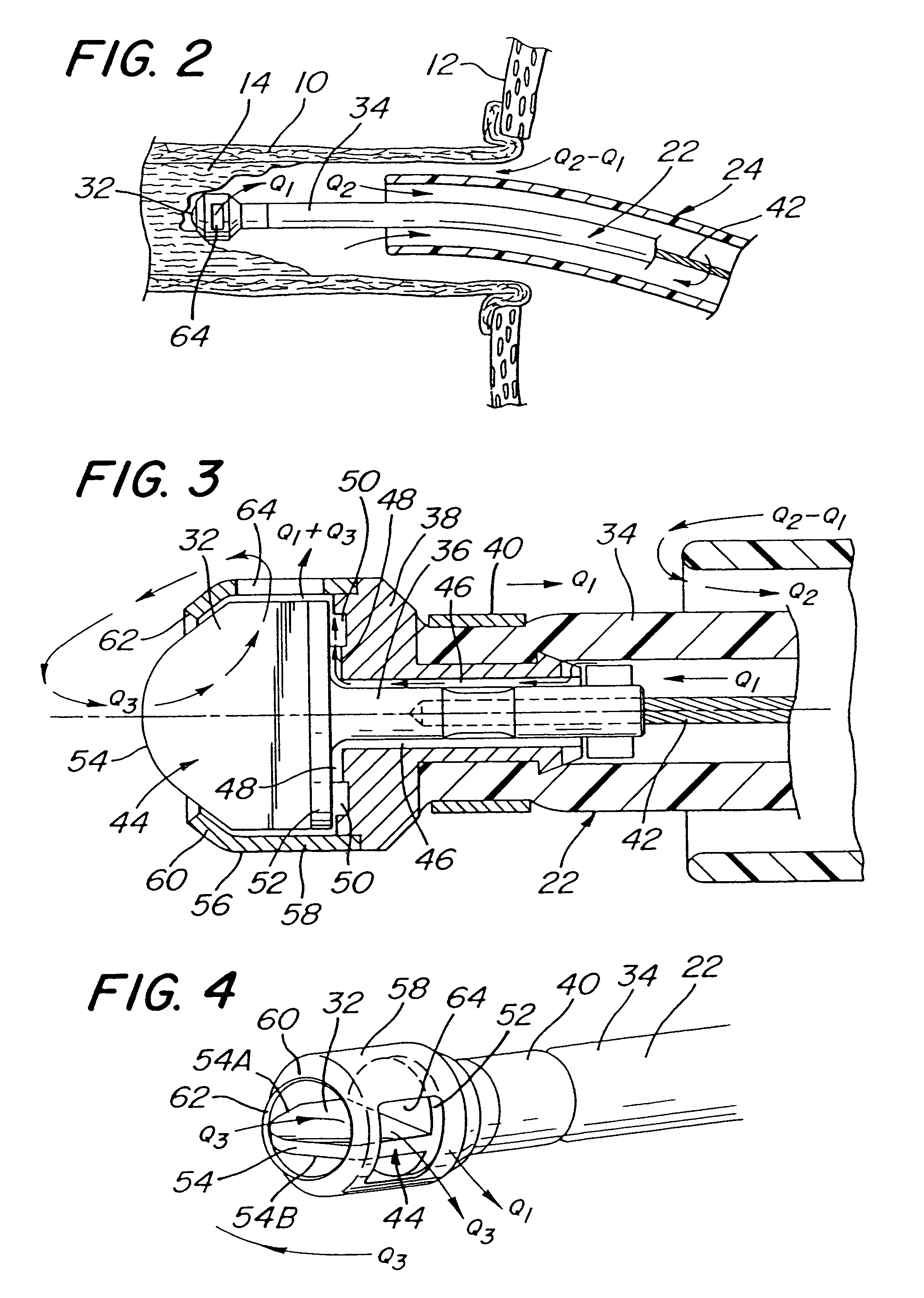 System and method of use for agent delivery and revascularizing of grafts and vessels