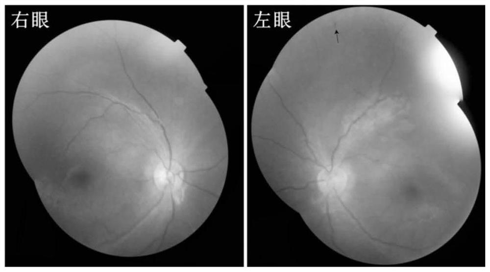 A pathogenic mutation of Leber's congenital amaurosis and its detection reagent