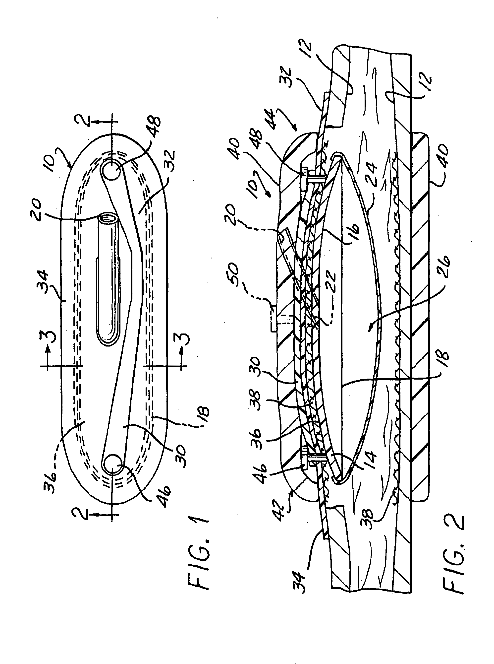 Stable aortic blood pump implant