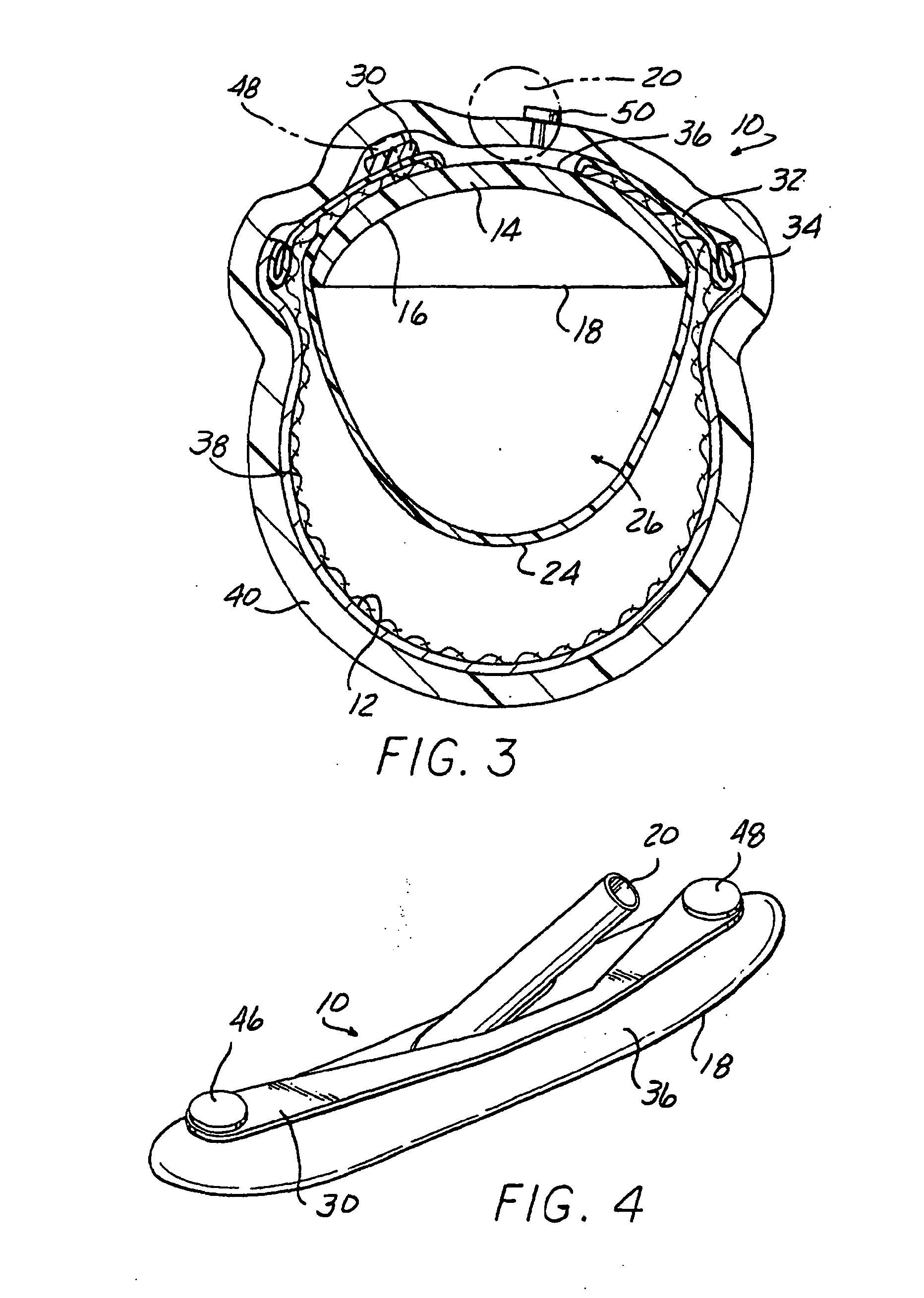 Stable aortic blood pump implant