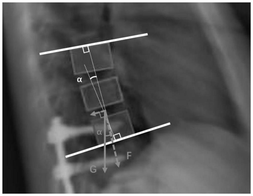 Spine near-end boundary angle operation optimization method based on finite elements and machine learning