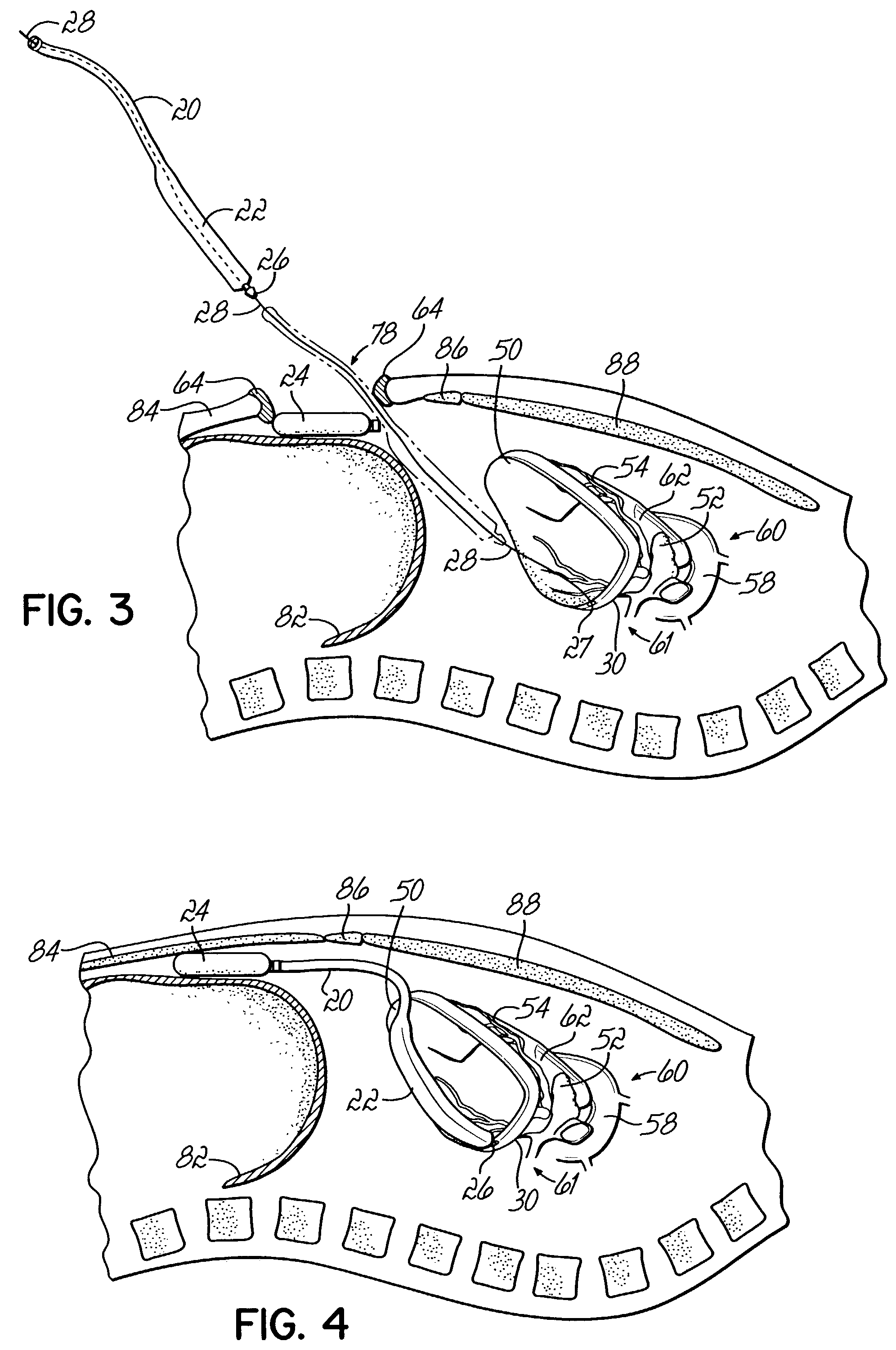 Modular power system and method for a heart wall actuation system for the natural heart