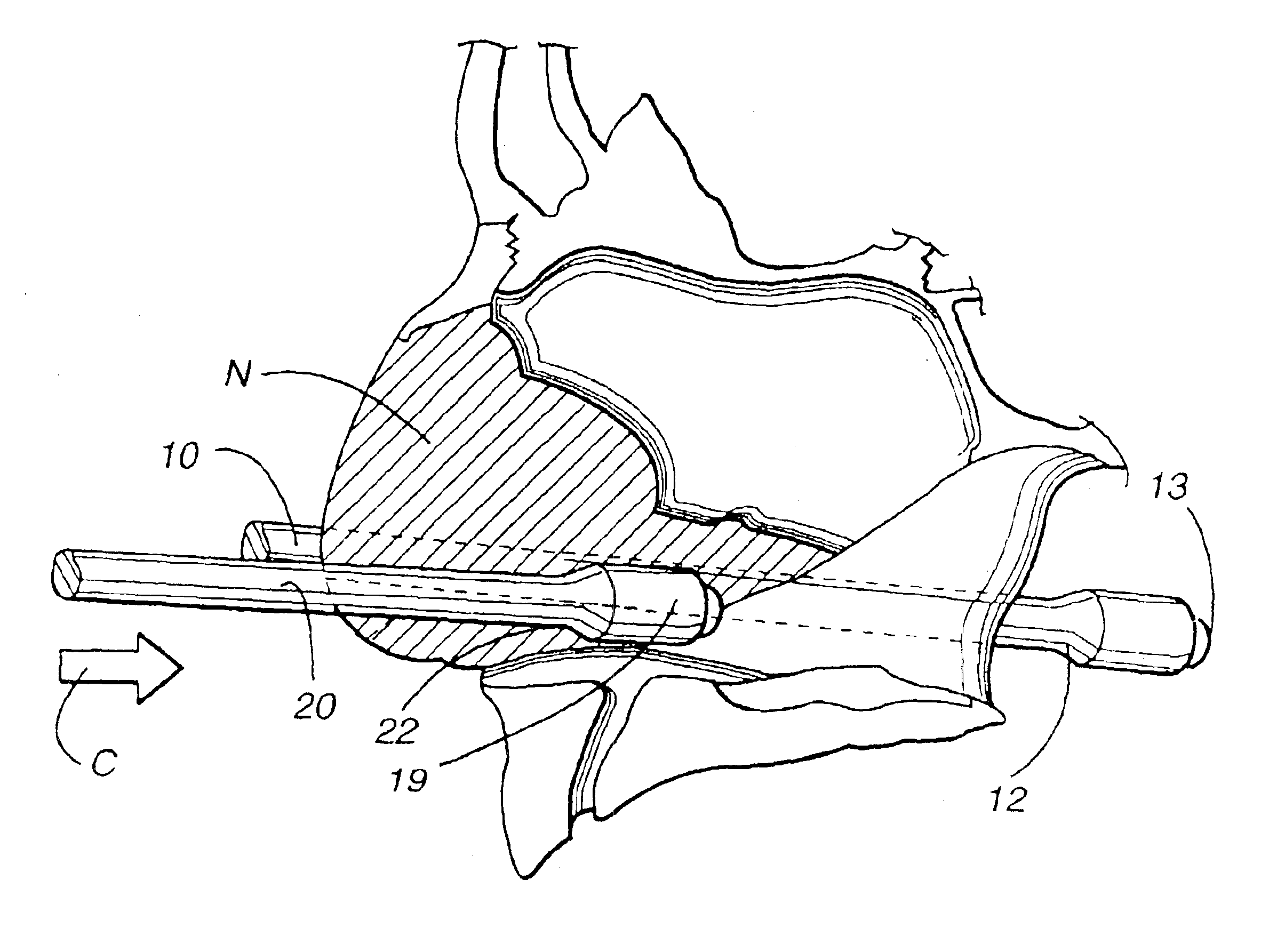 Magnetic nasal tube bridle system and related method