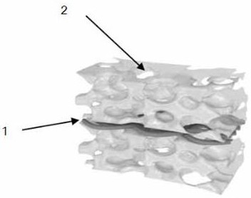 An implantable anti-tumor dressing and its preparation method