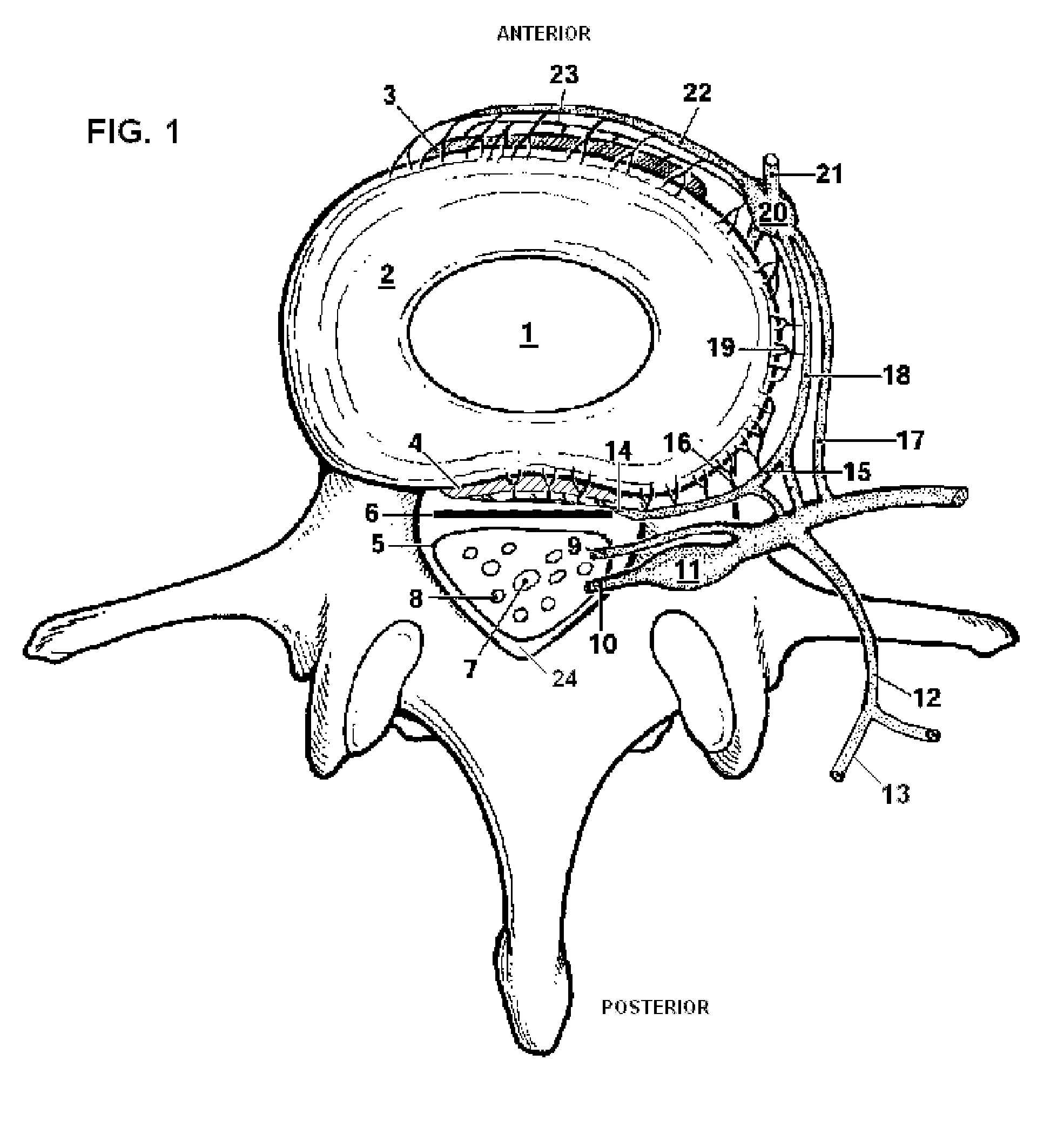 System and method for electrical stimulation of the lumbar vertebral column
