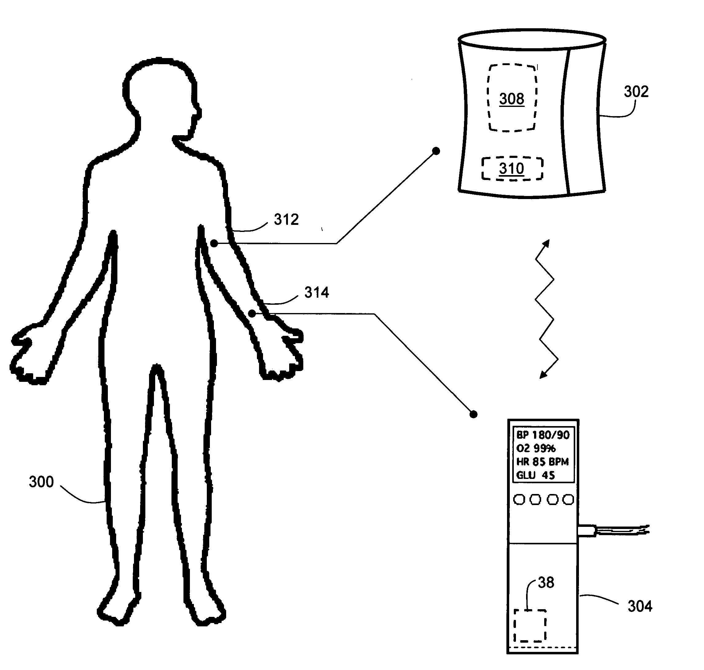 Blood-pressure monitoring device featuring a calibration-based analysis