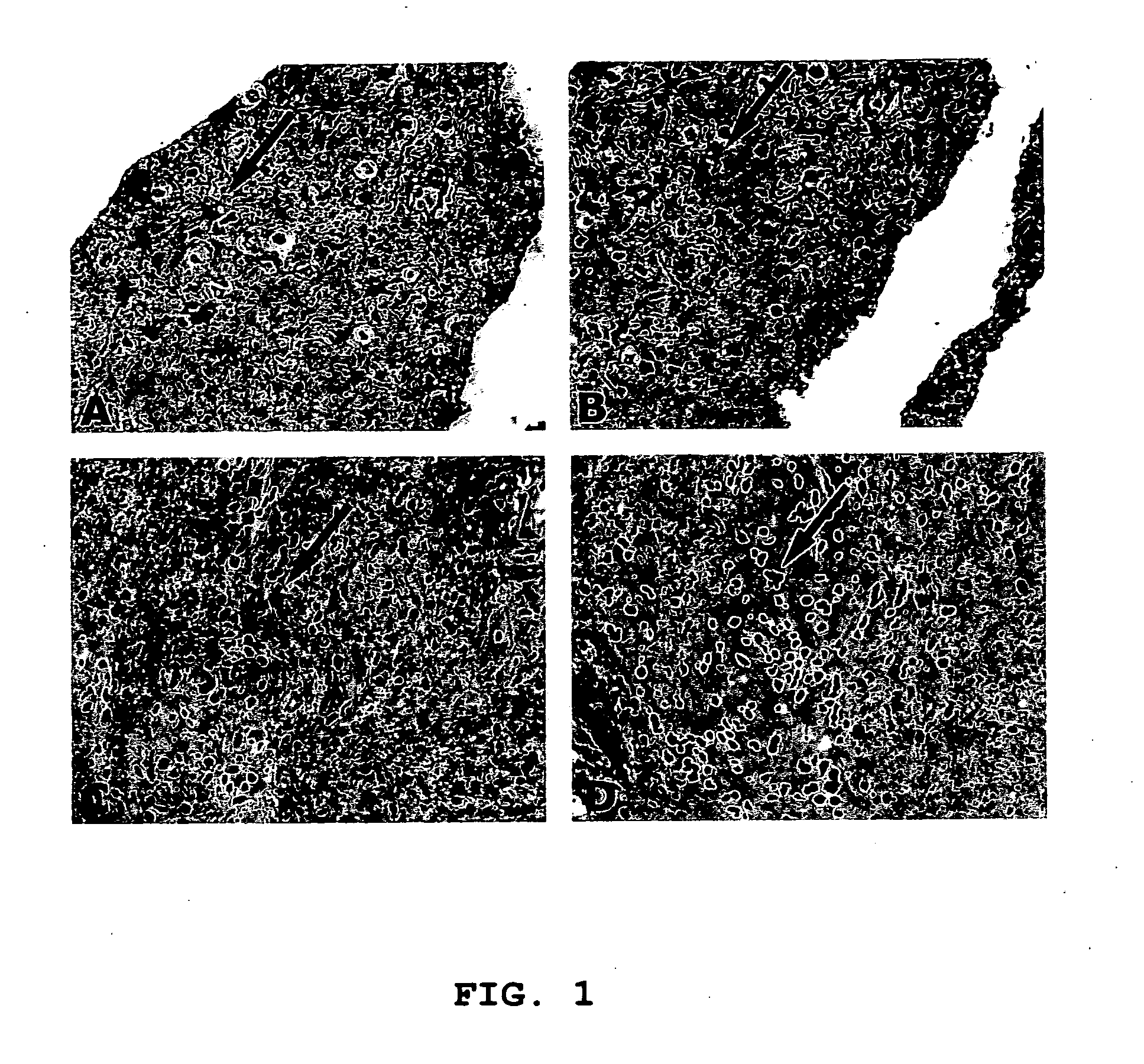 Methods for diagnosis of low grade astrocytoma