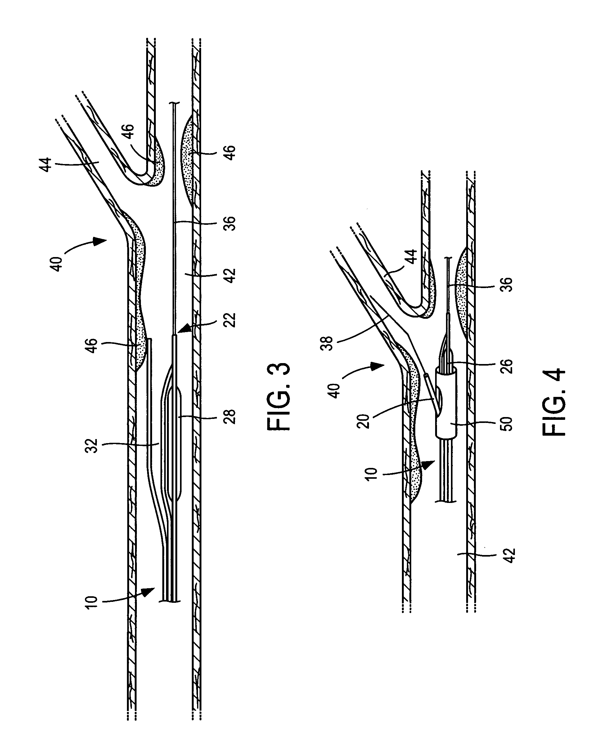 Catheter balloon systems and methods