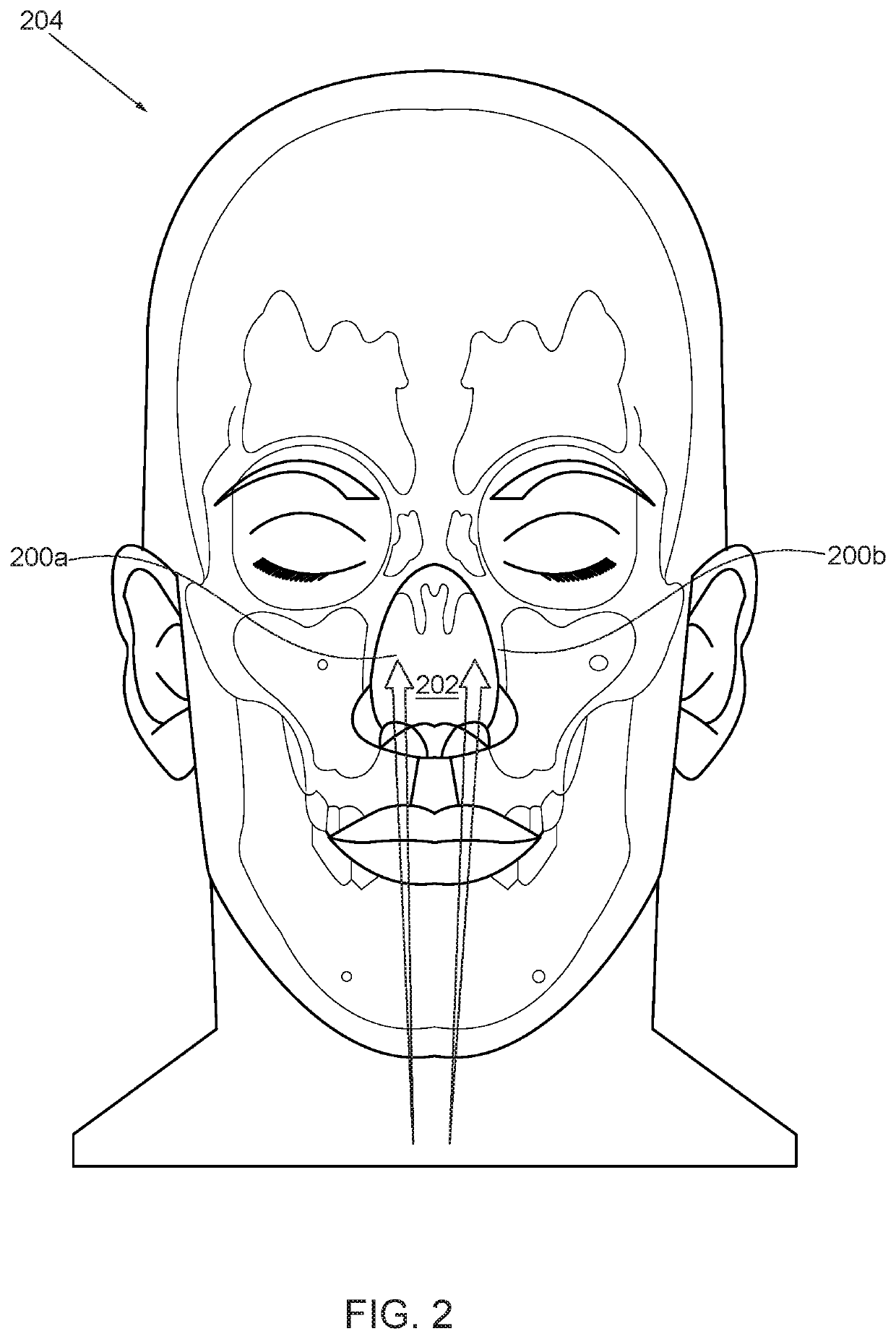 Method for intranasal stem cell therapy