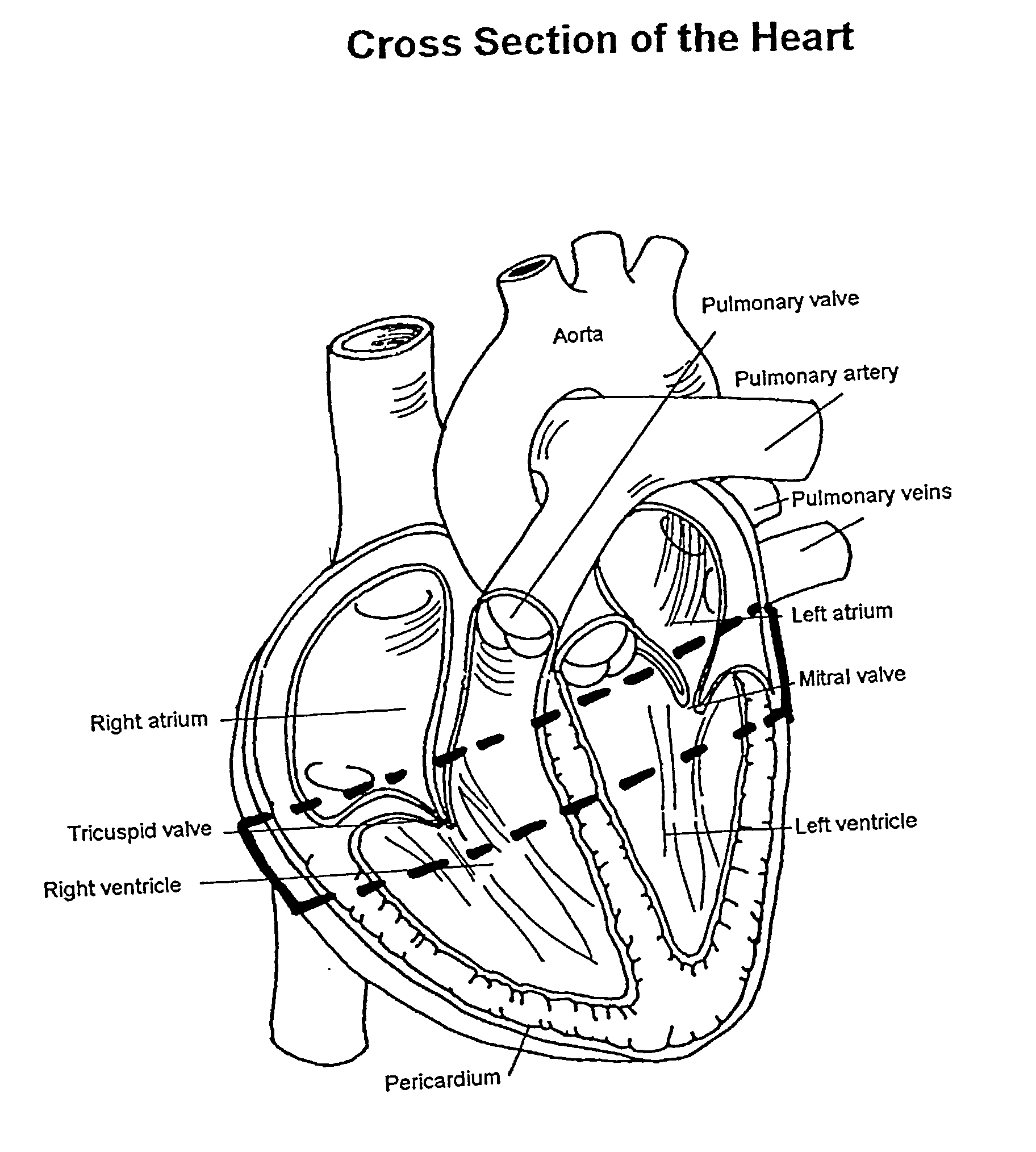 Method and apparatus for external stabilization of the heart