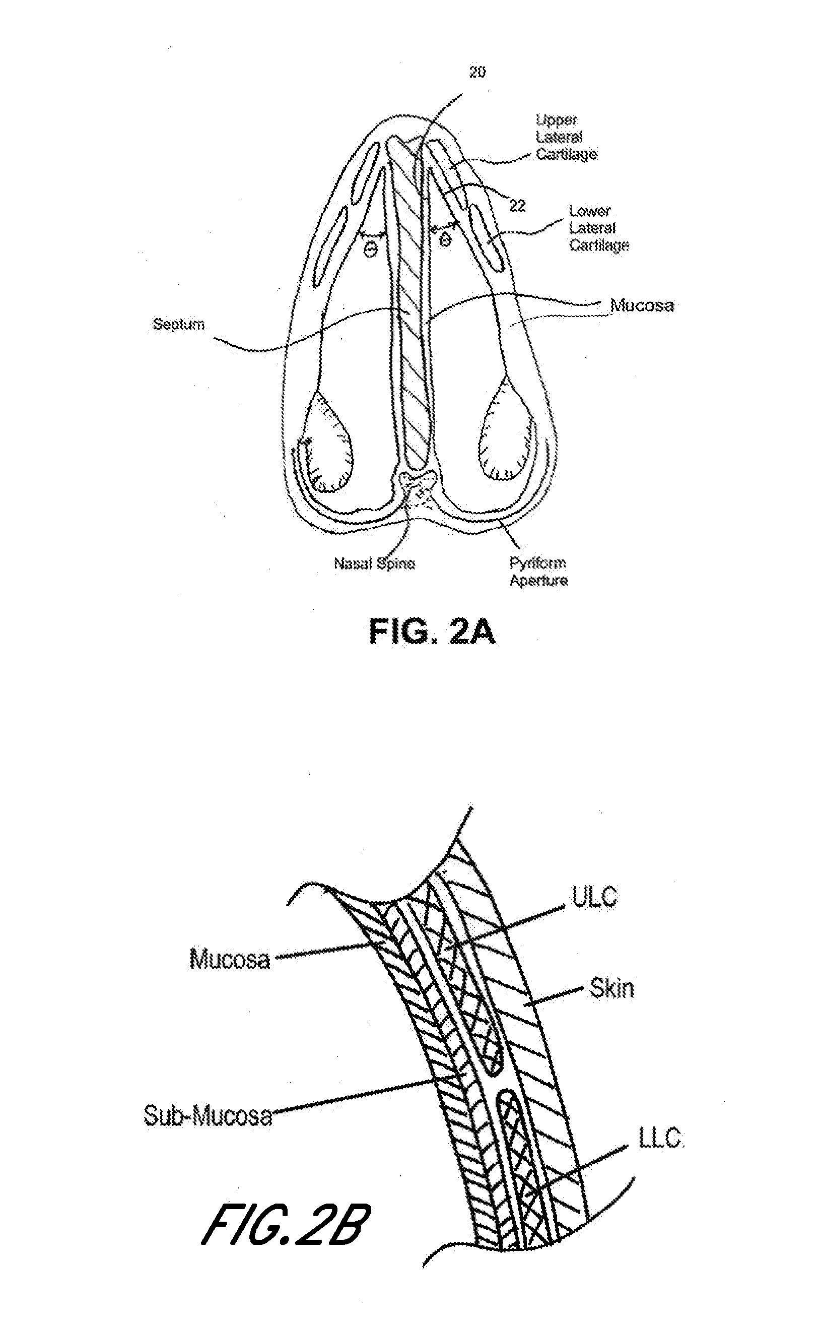 Methods and devices to treat nasal airways