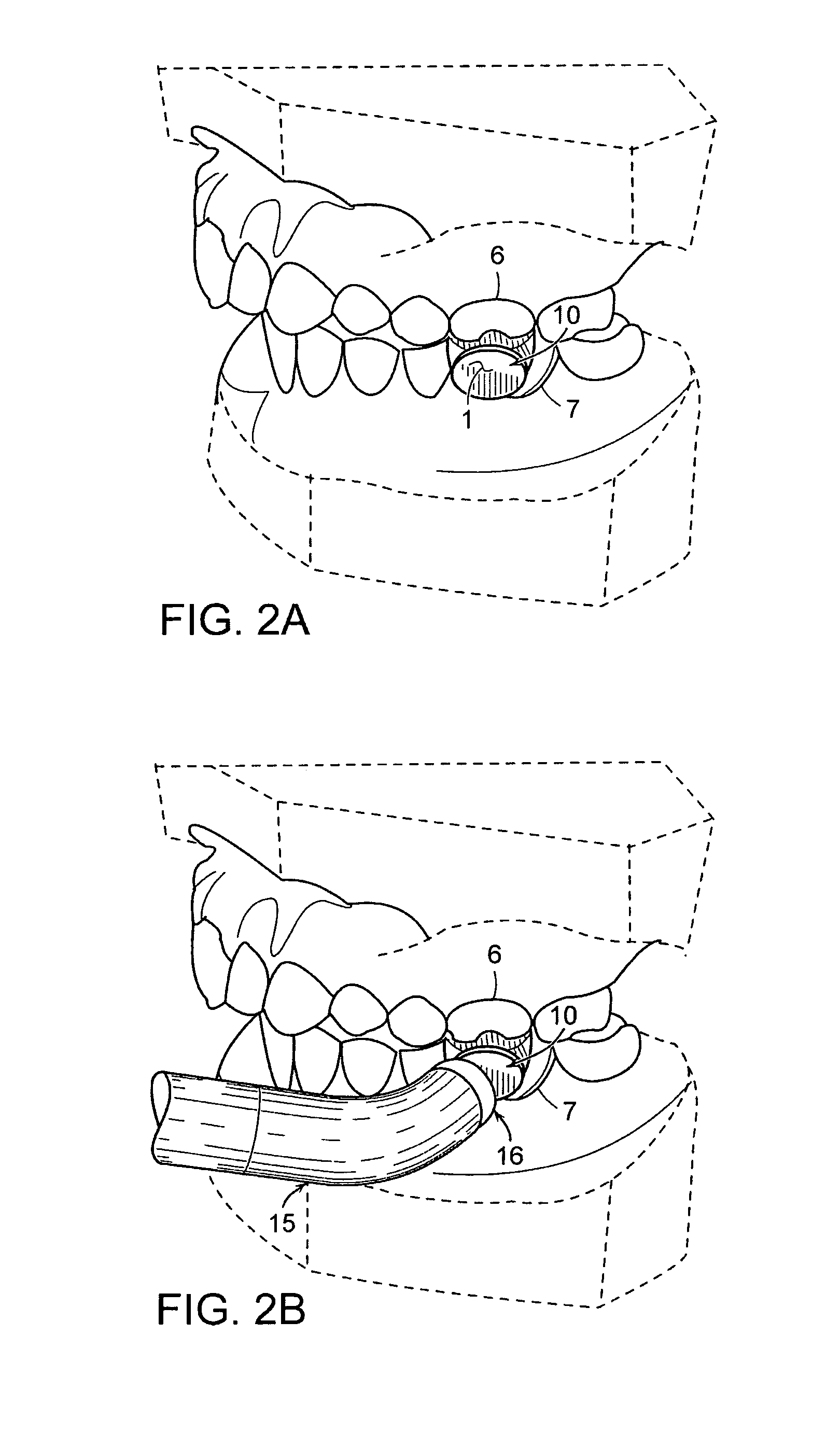 Dental light curing member and method