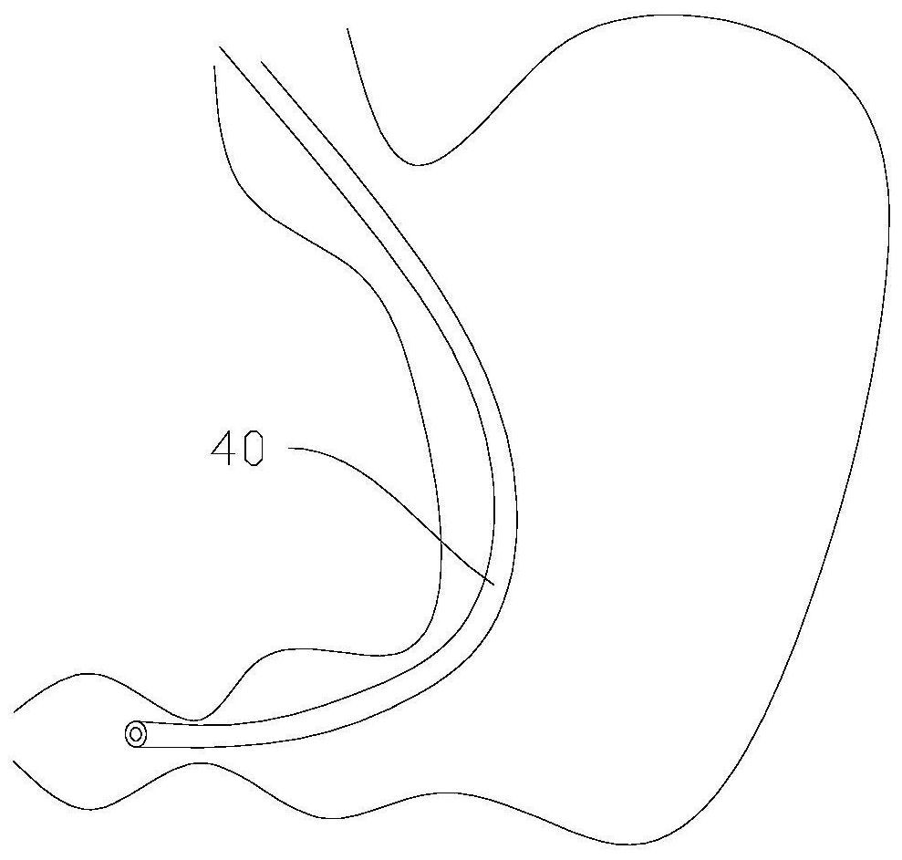 Guiding device in gastrectomy